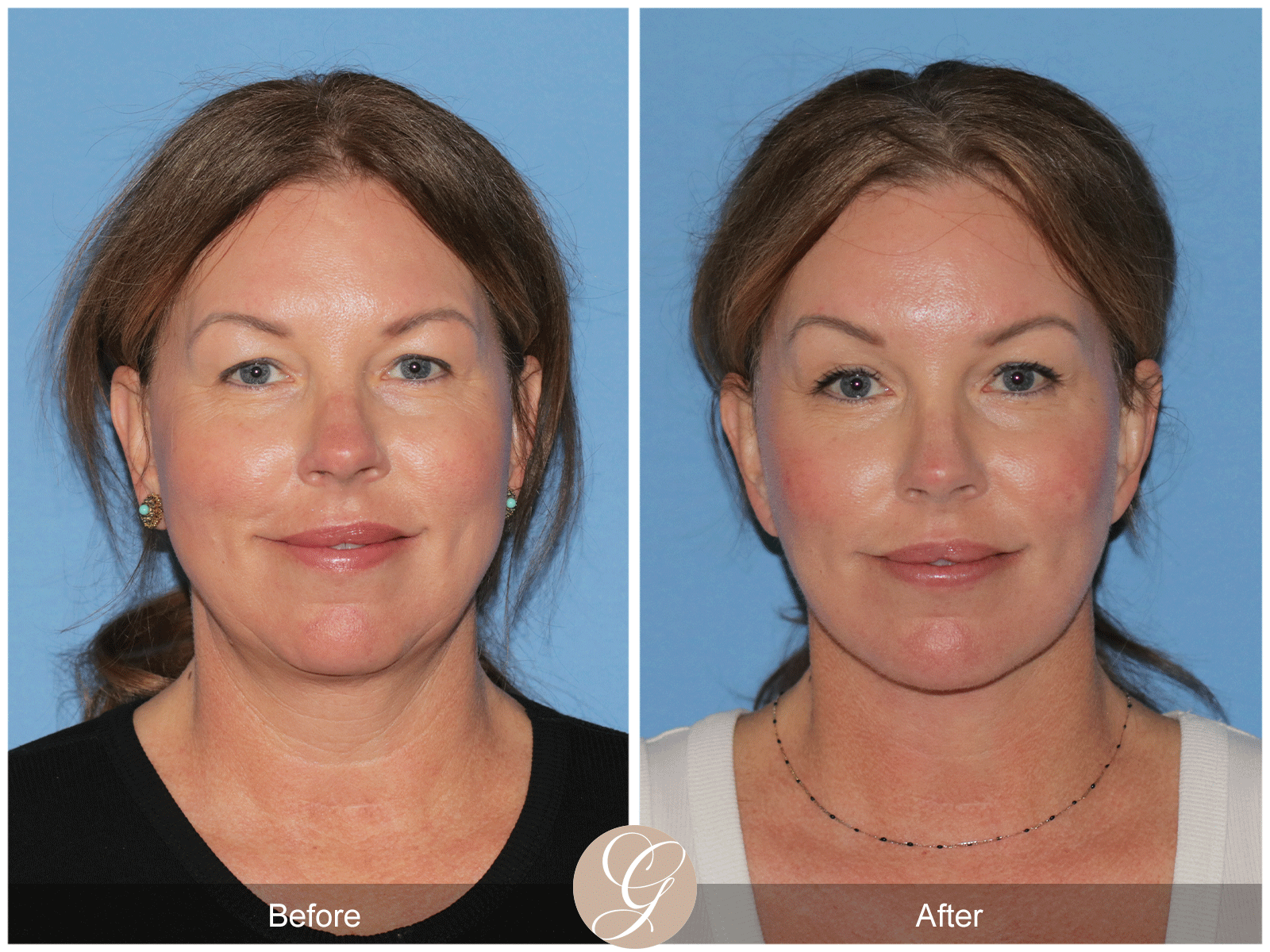 Deep Plane Facelift Case 33 Image