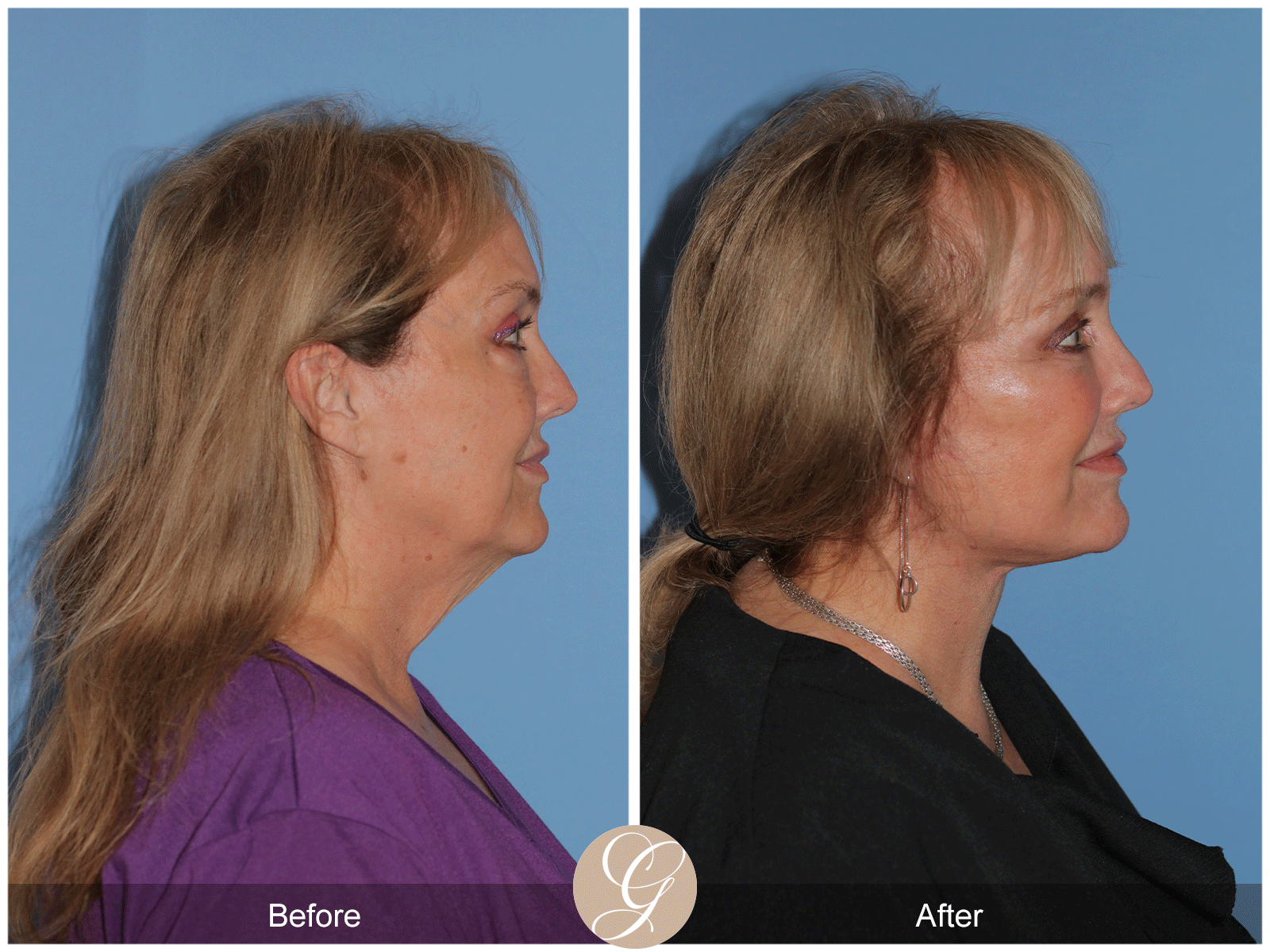 Deep Plane Facelift Case 48 Image