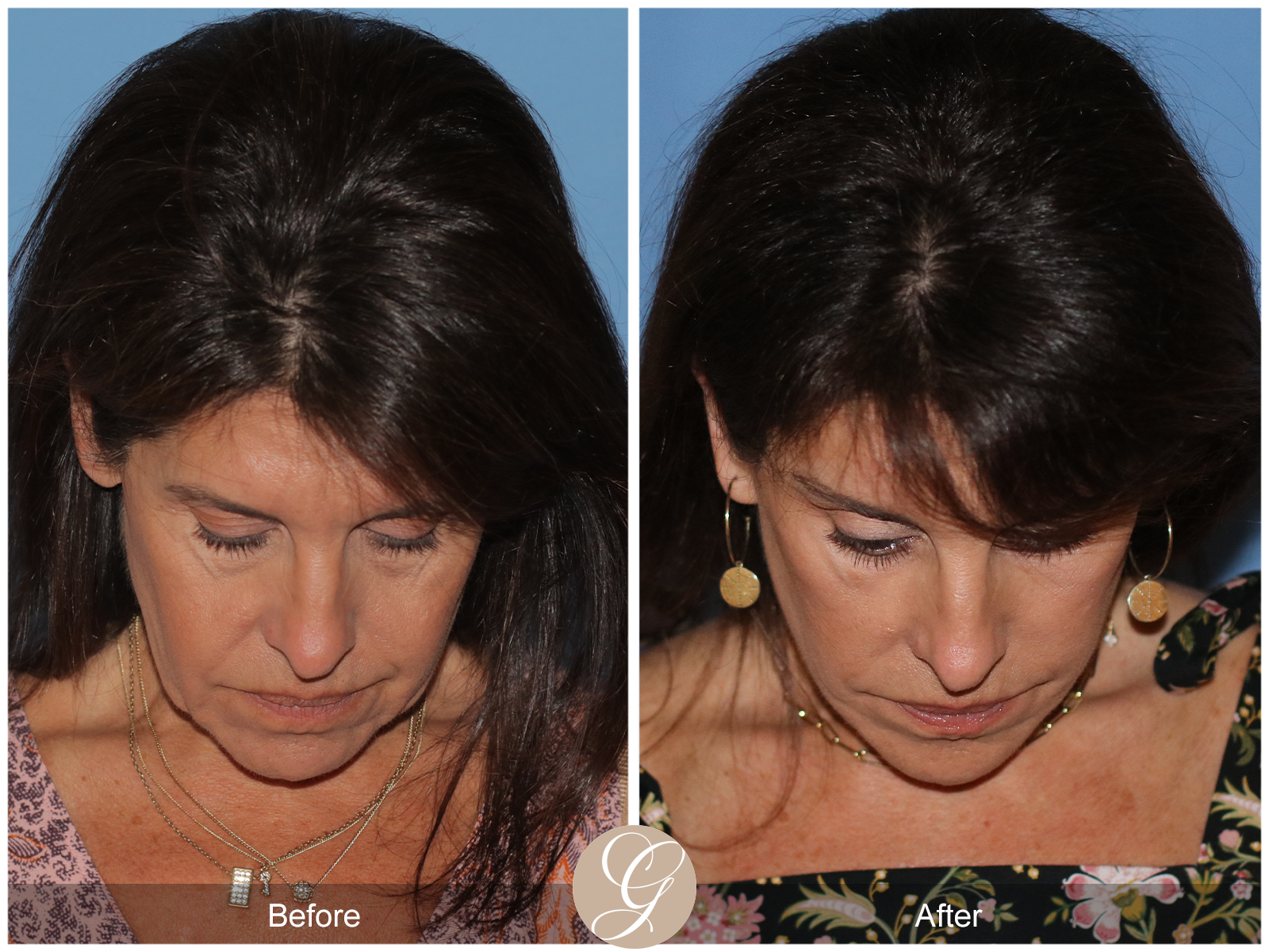 Deep Plane Facelift Case 32 Image