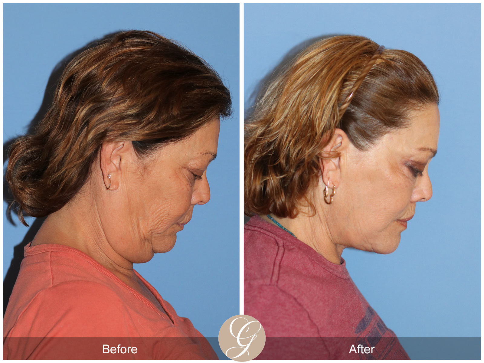 Deep Plane Facelift Case 37 Image