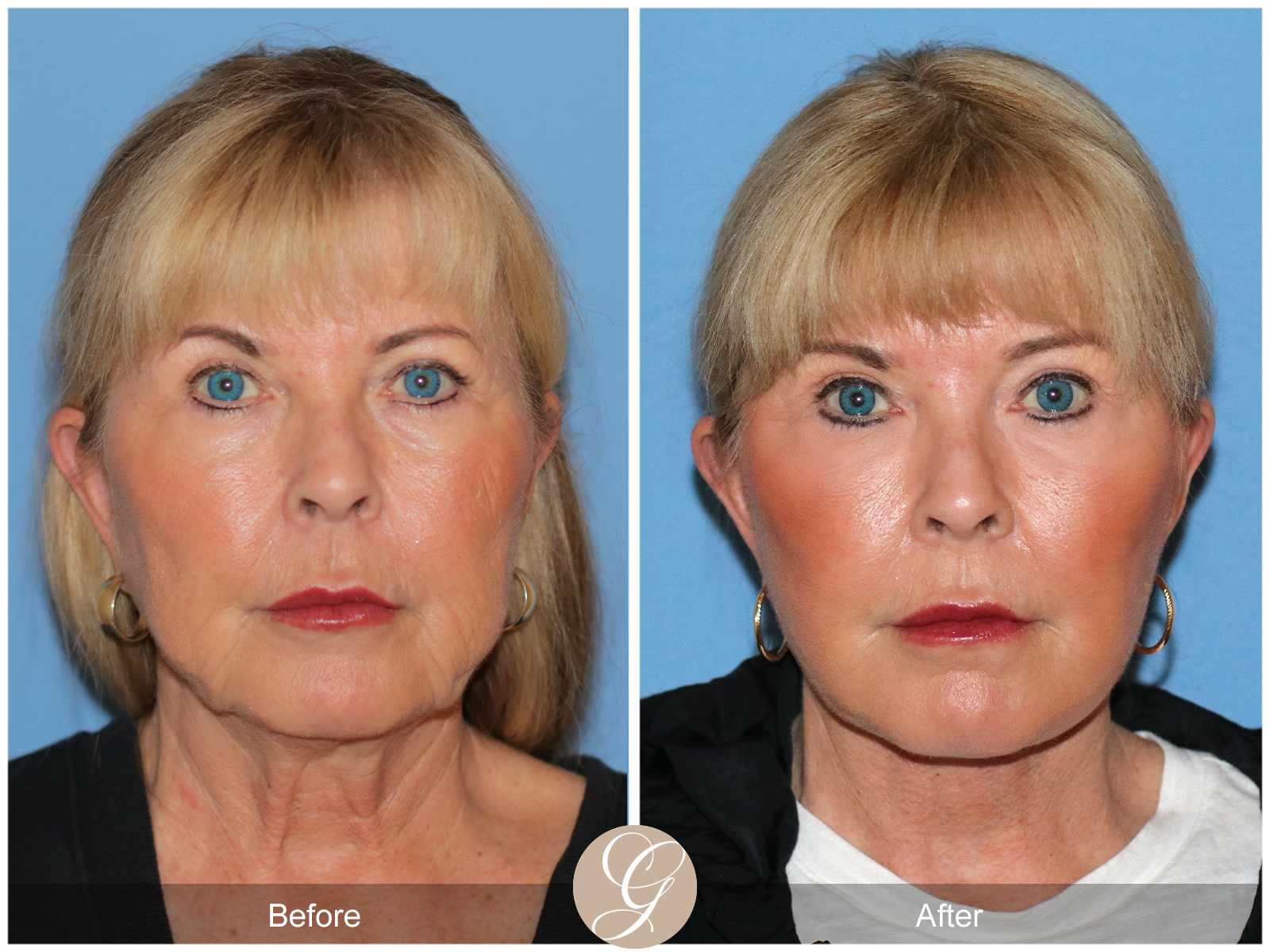 Preservation Deep Plane Facelift Case 35 Image