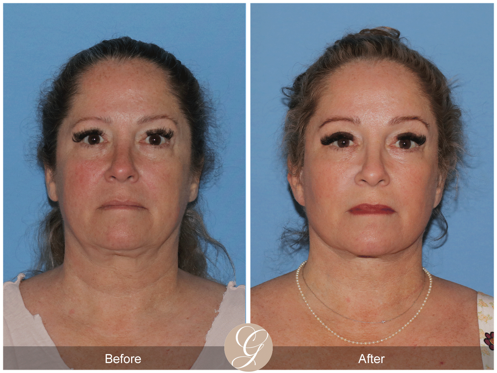 Deep Plane Facelift Case 28 Image