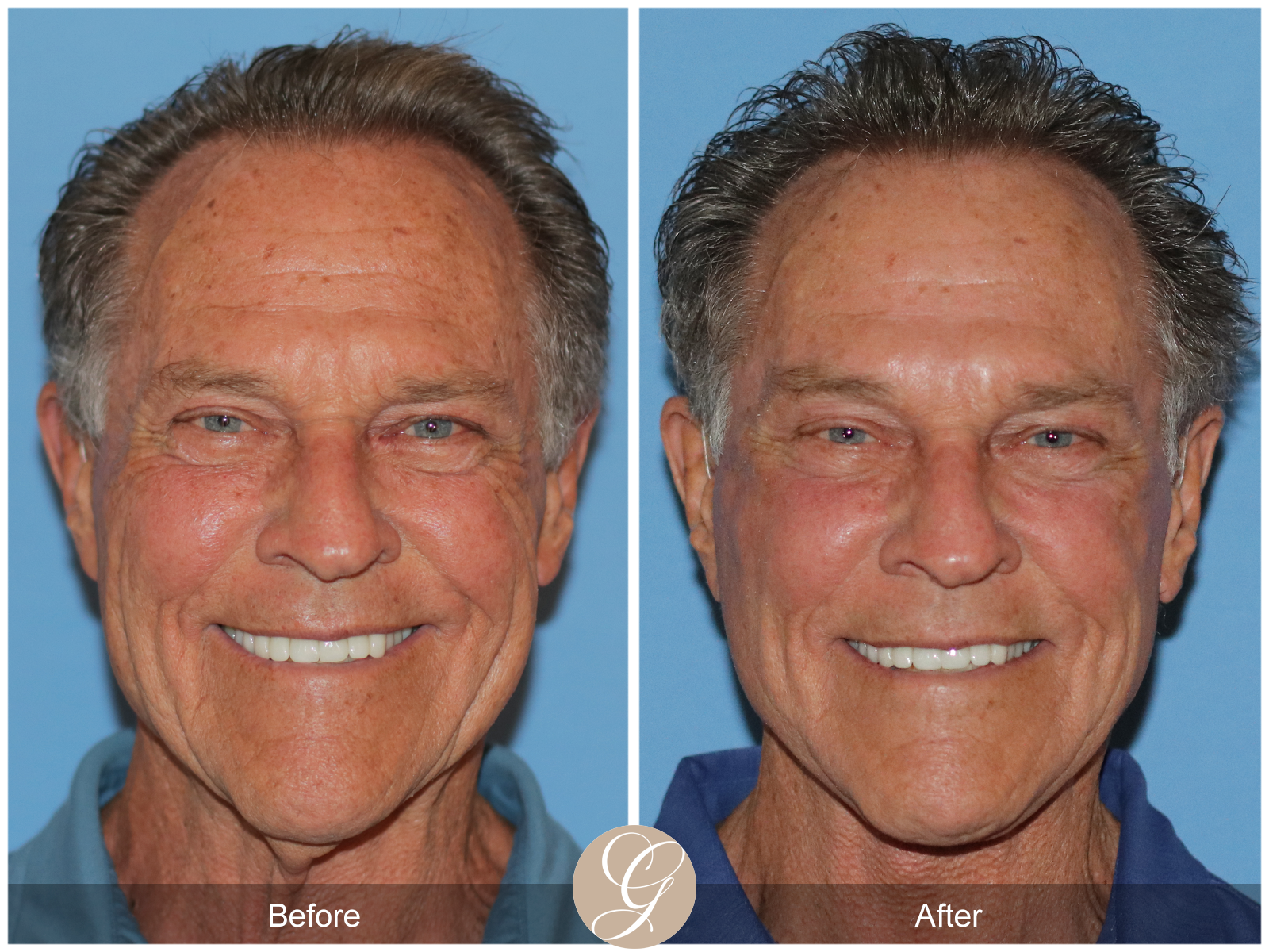 Preservation Deep Plane Facelift Case 36 Image