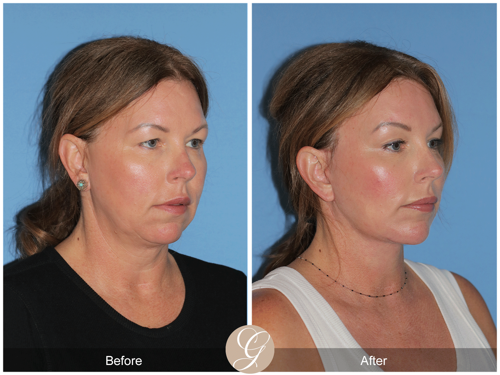 Deep Plane Facelift Case 33 Image