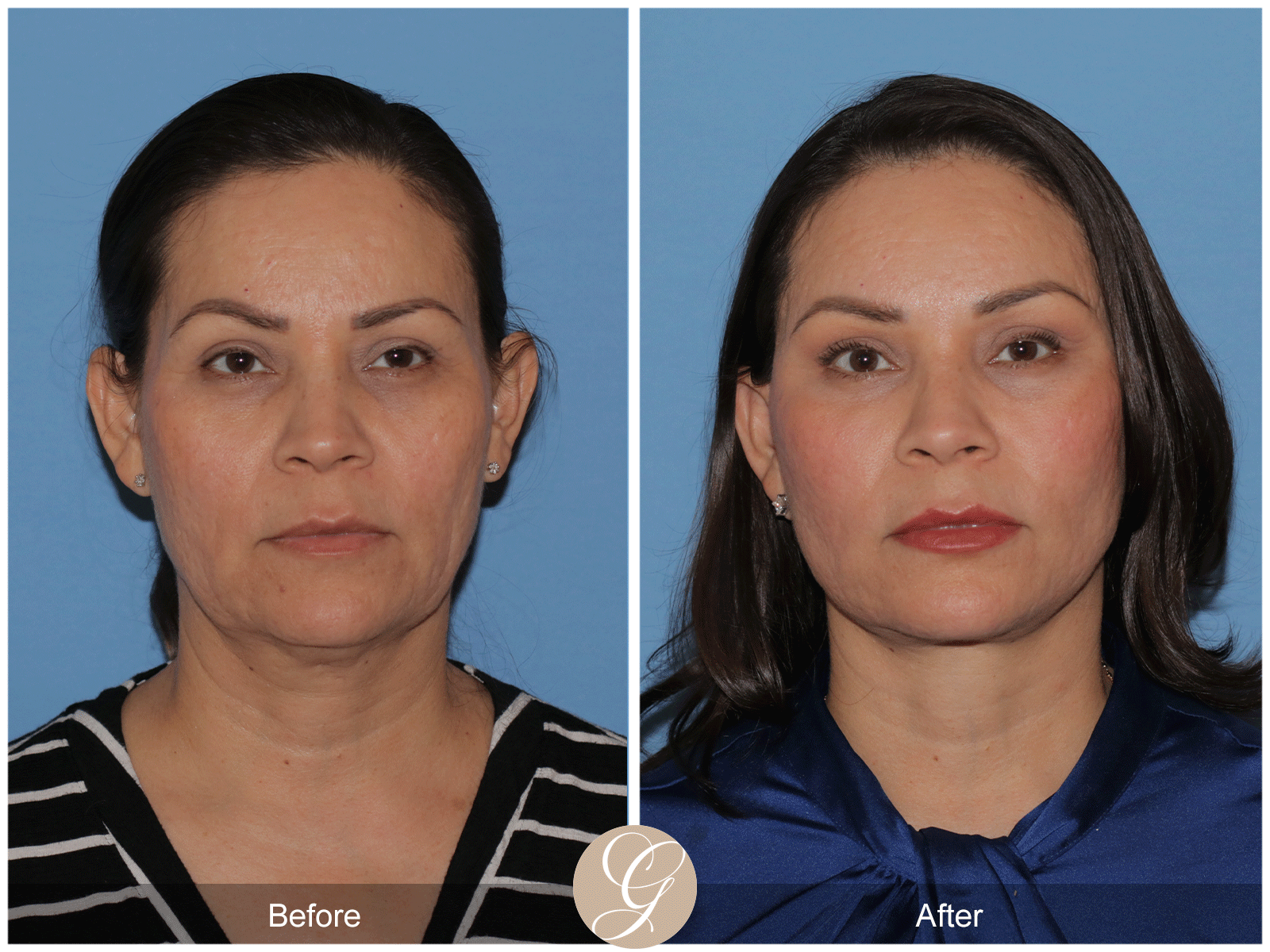 Deep Plane Facelift Case 27 Image