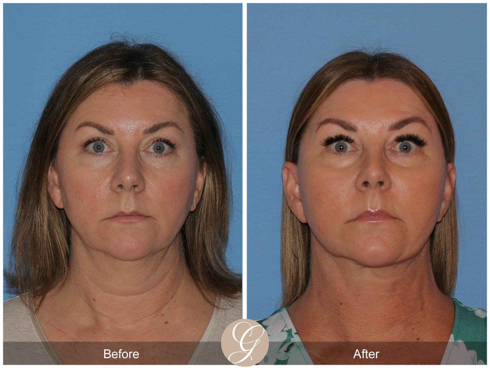 Preservation Deep Plane Facelift Case 37 Image