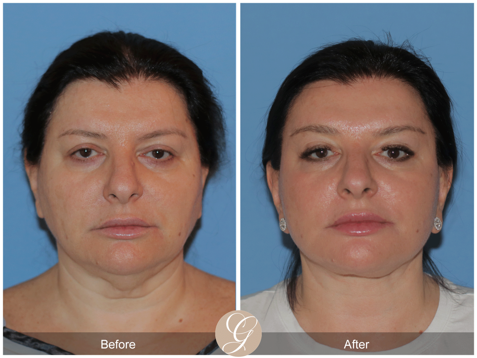 Preservation Deep Plane Facelift Case 40 Image