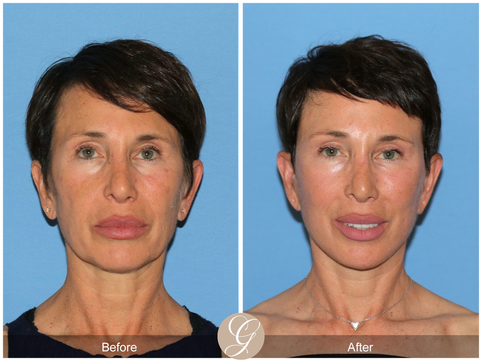 Deep Plane Facelift Case 47 Image