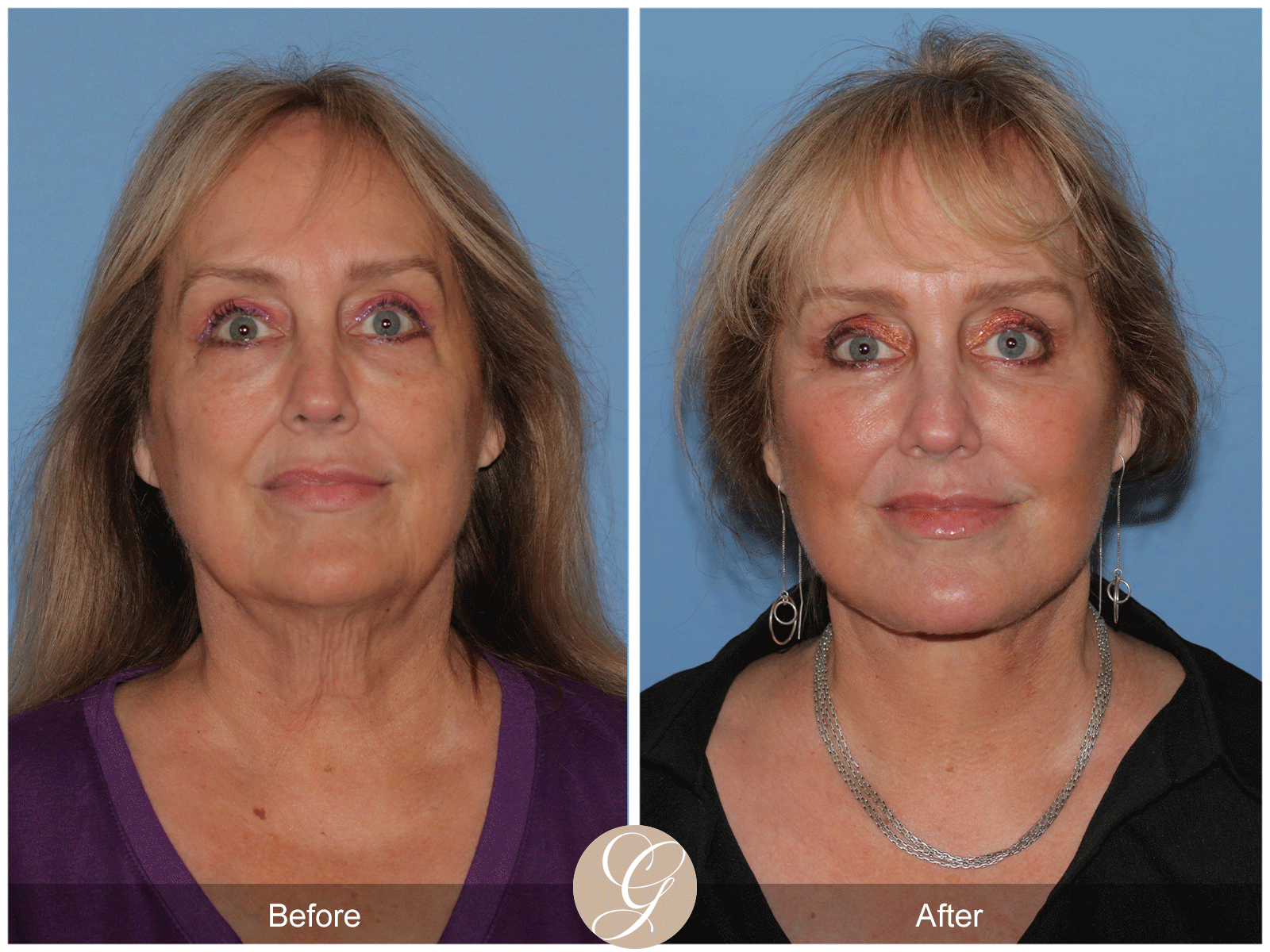 Deep Plane Facelift Case 48 Image