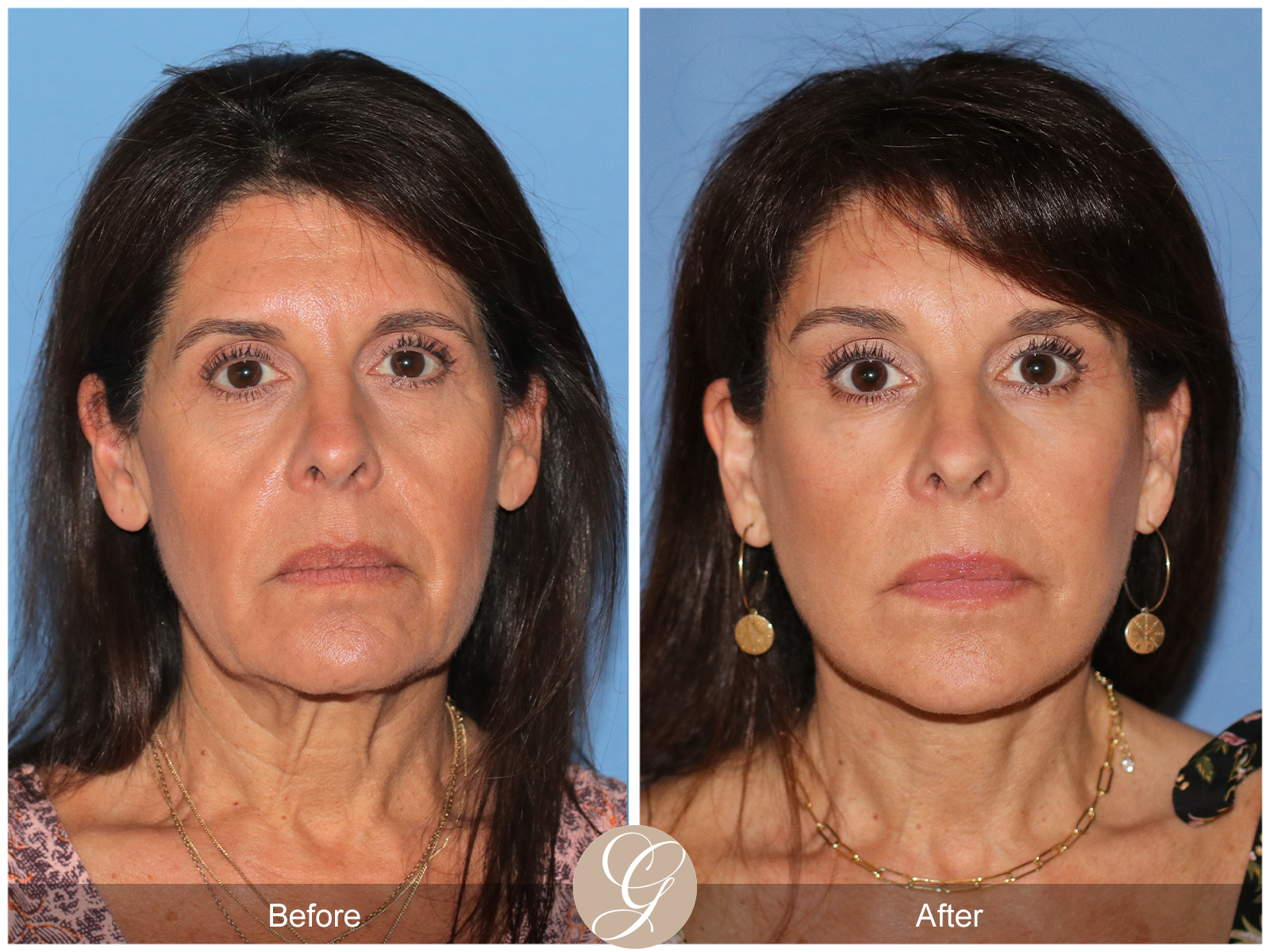 Deep Plane Facelift Case 32 Image