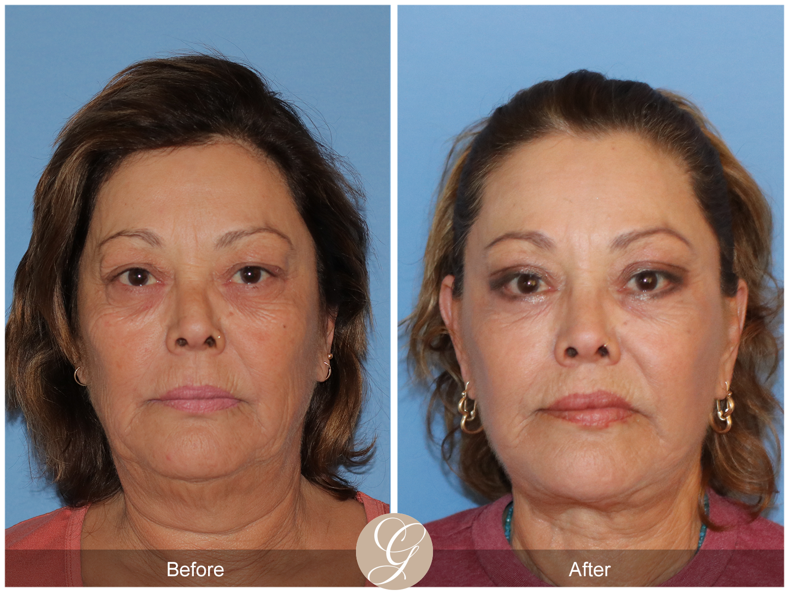 Deep Plane Facelift Case 37 Image