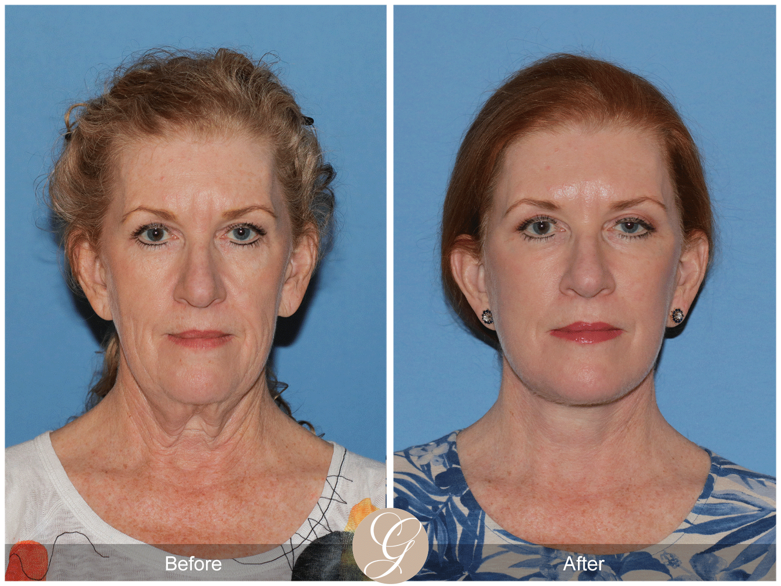 Deep Plane Facelift Case 30 Image