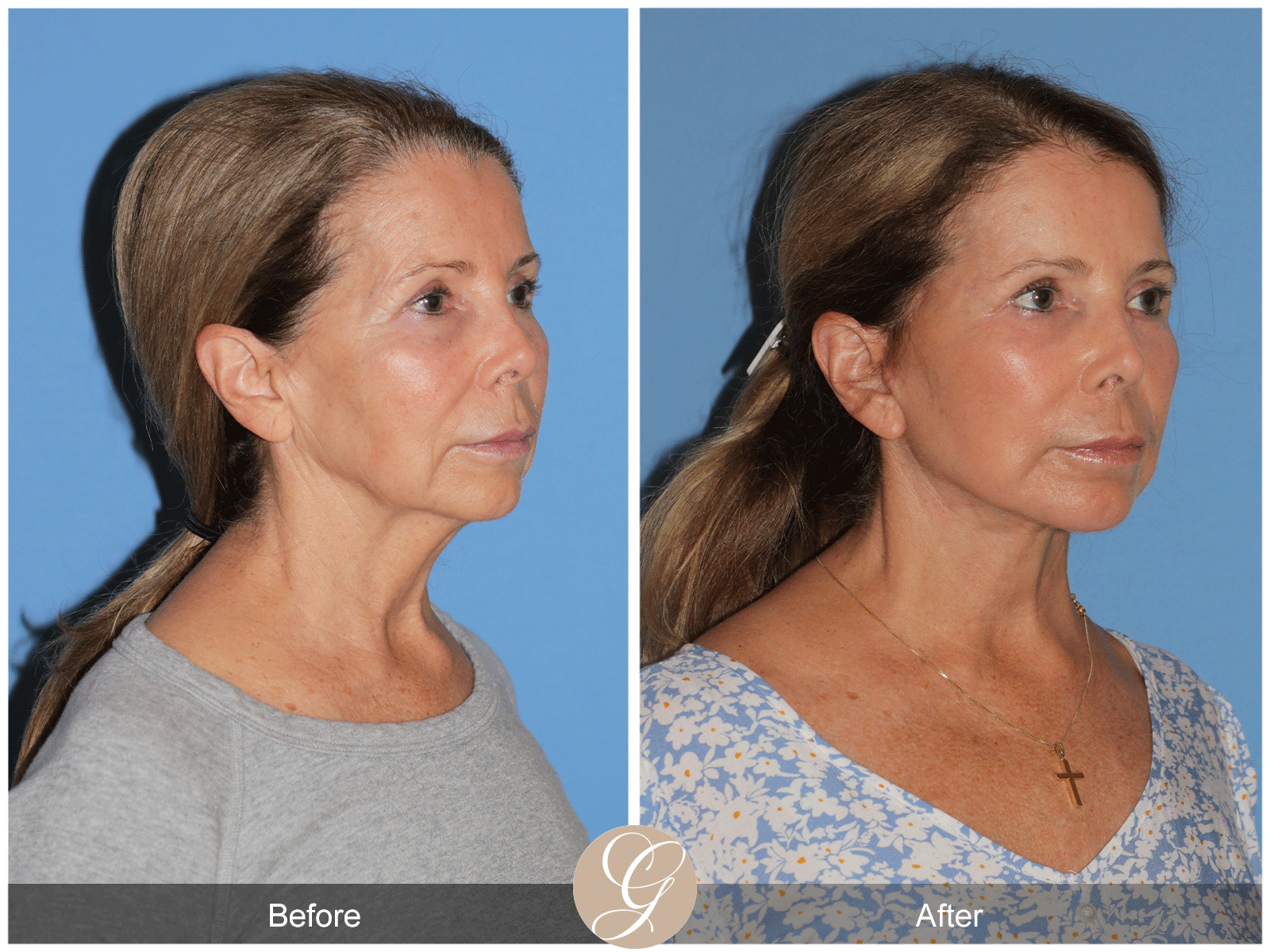 Preservation Deep Plane Facelift Case 44 Image