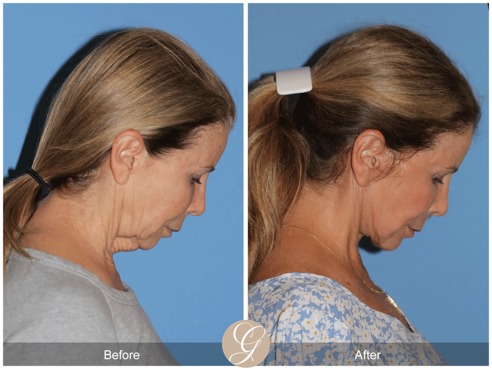 Preservation Deep Plane Facelift Case 44 Image