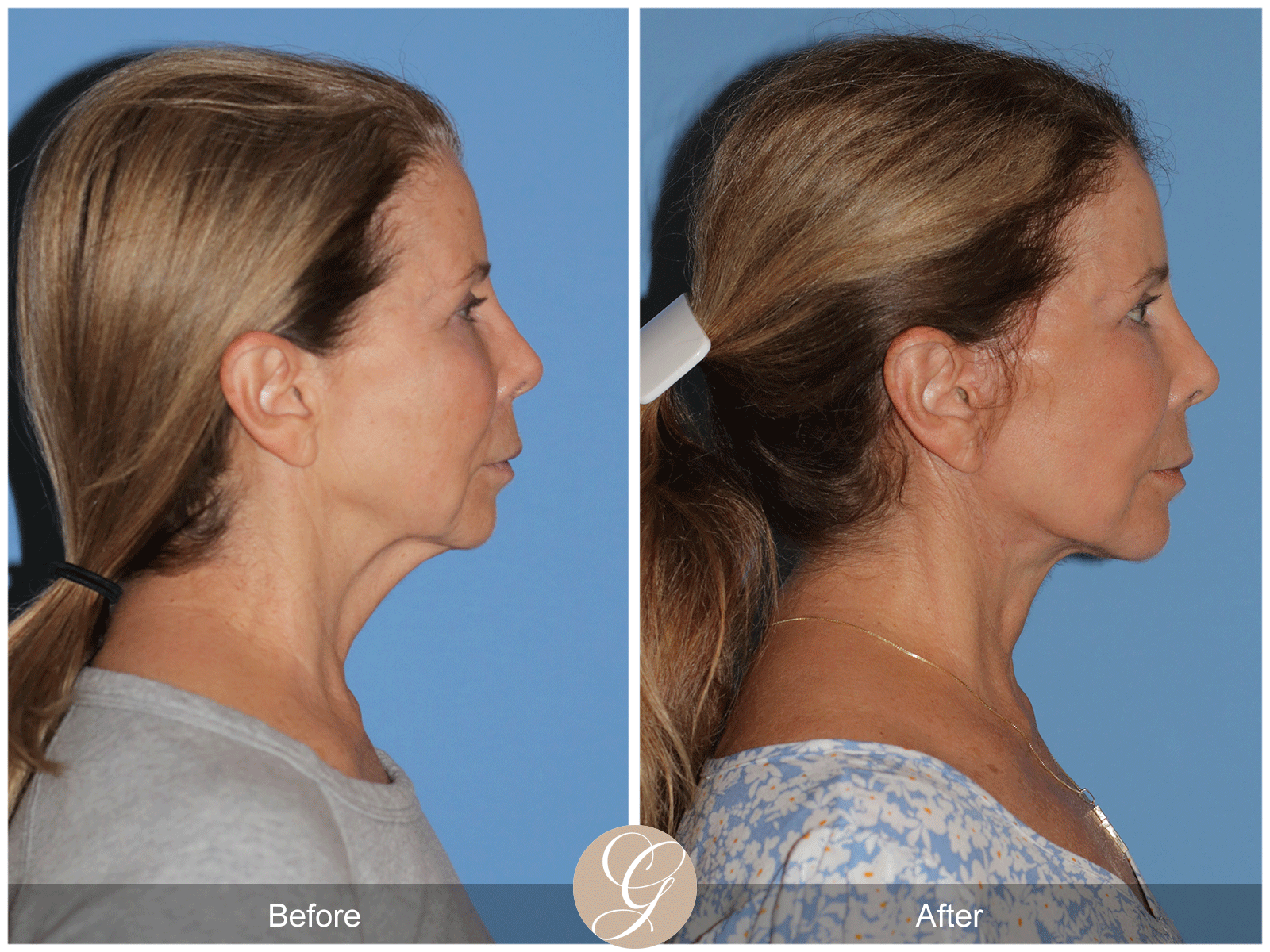 Preservation Deep Plane Facelift Case 44 Image