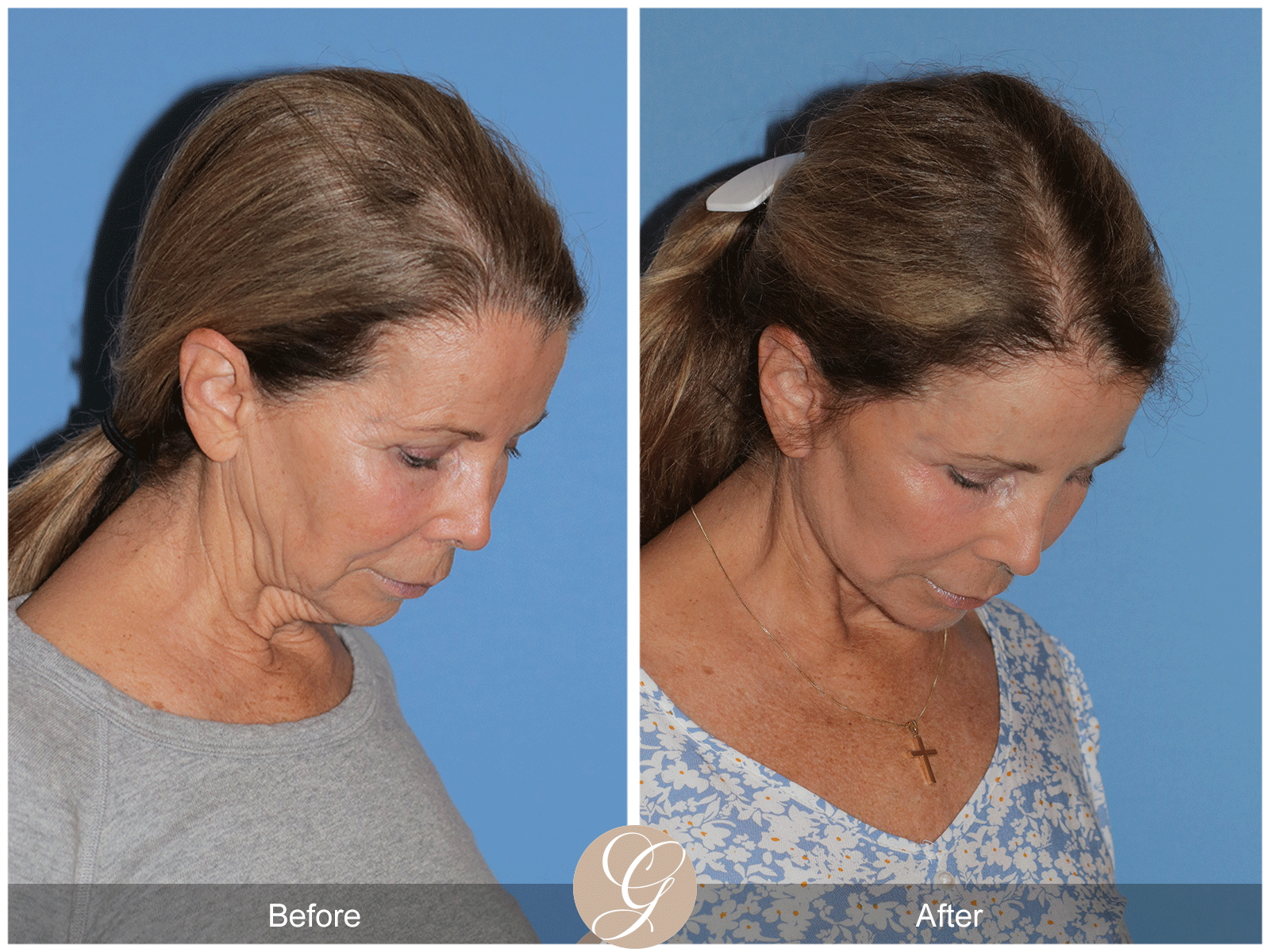 Preservation Deep Plane Facelift Case 44 Image