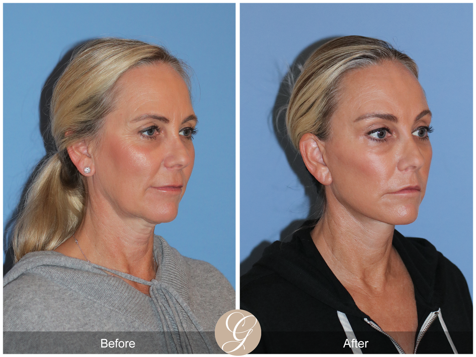 Deep Plane Facelift Case 41 Image