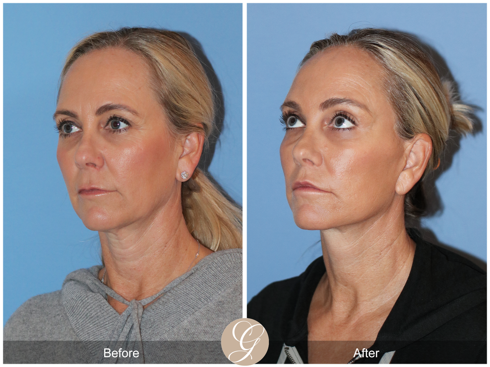 Deep Plane Facelift Case 41 Image