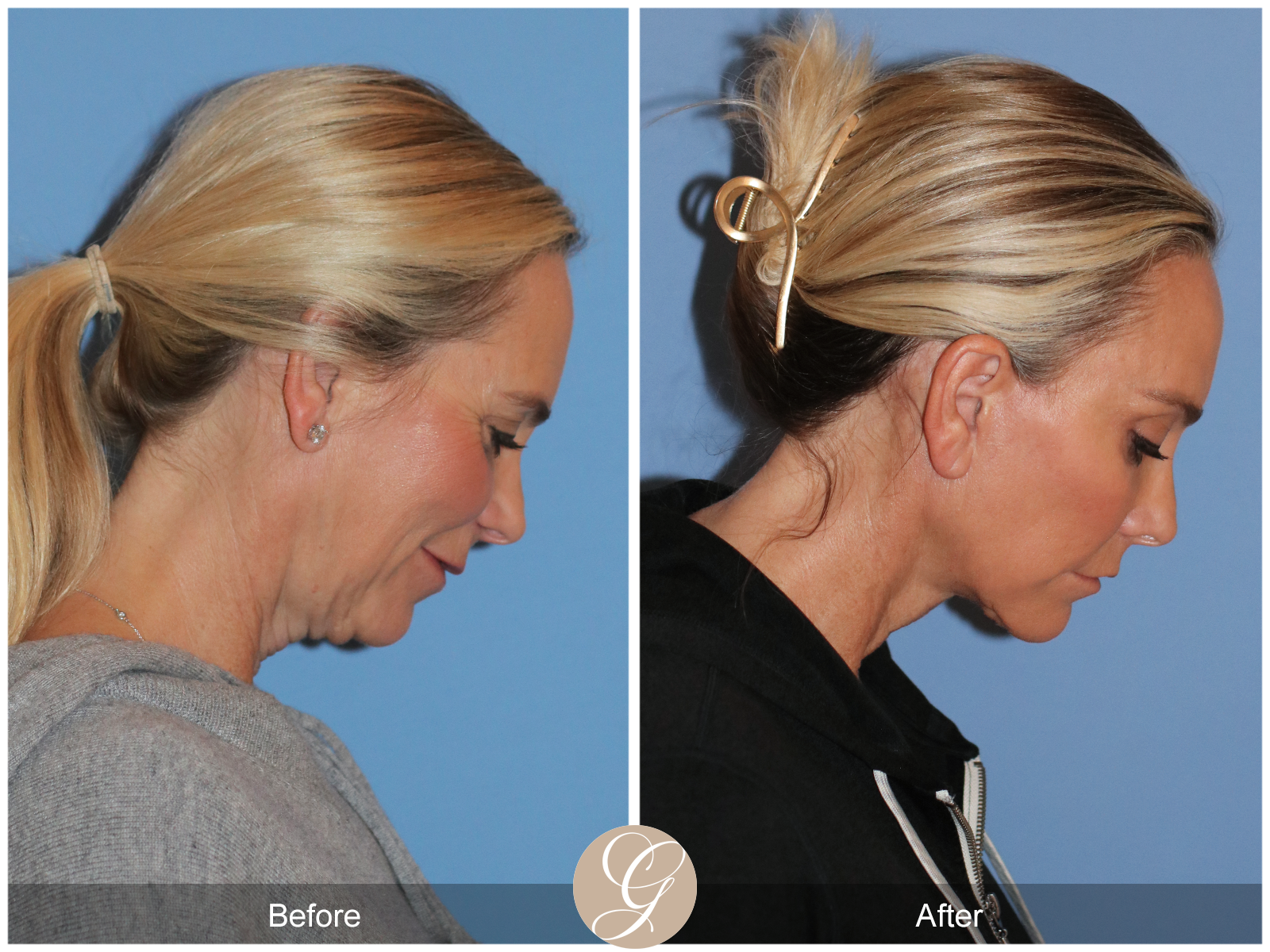 Deep Plane Facelift Case 41 Image