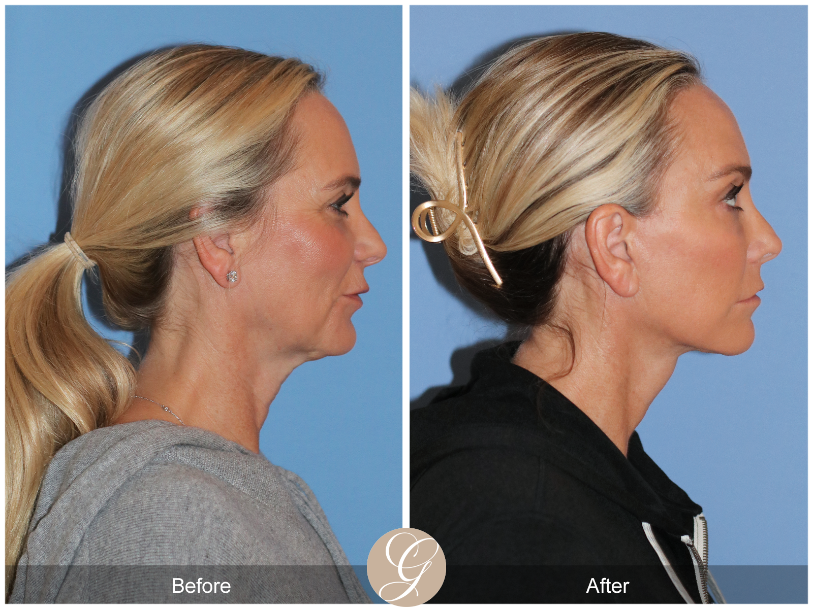 Deep Plane Facelift Case 41 Image