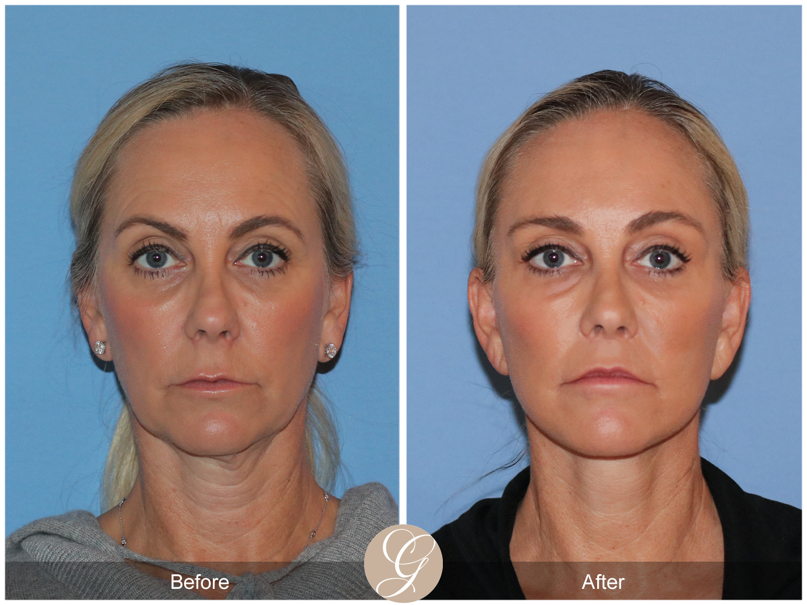 Deep Plane Facelift Case 41 Image