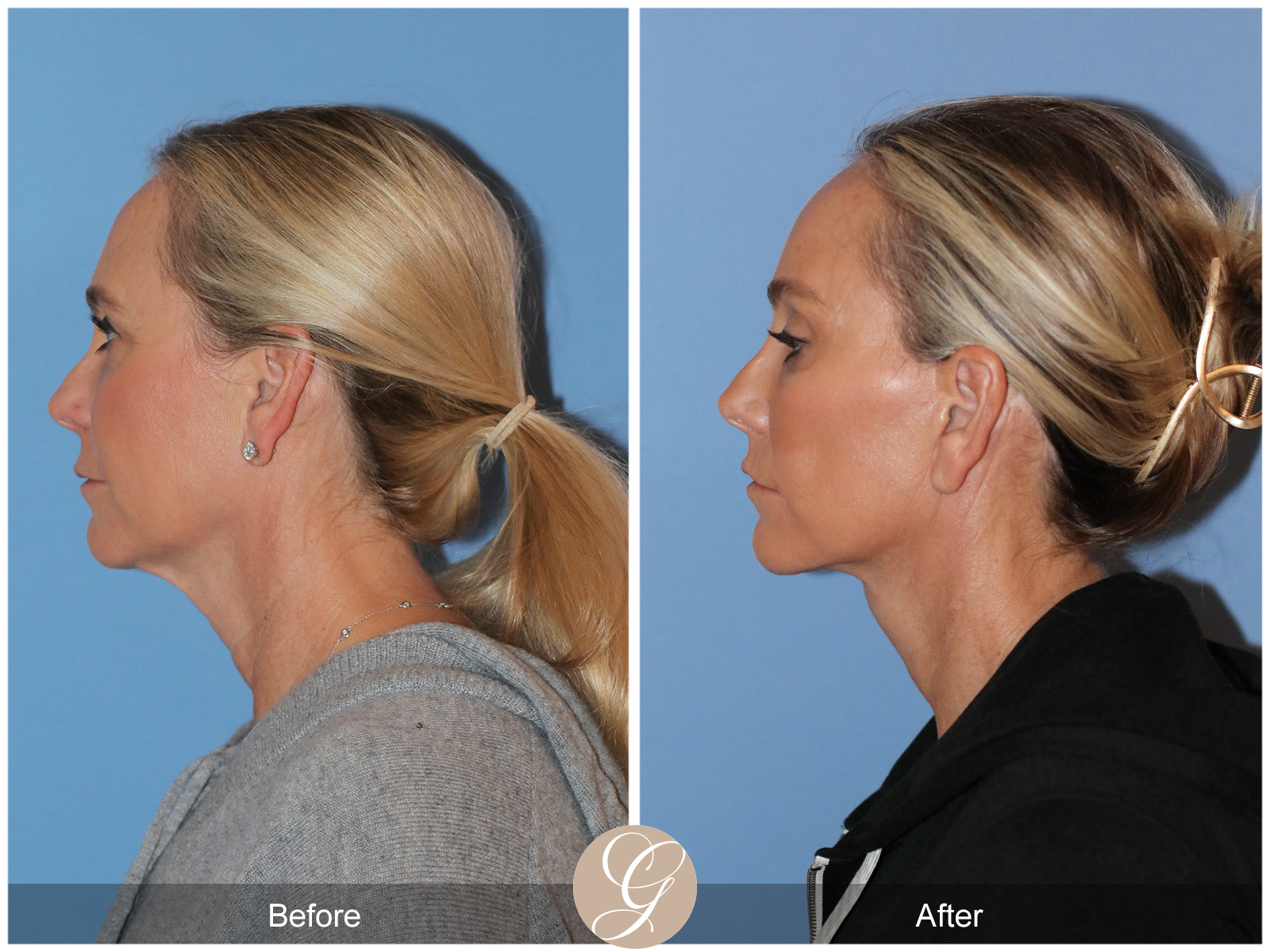 Deep Plane Facelift Case 41 Image
