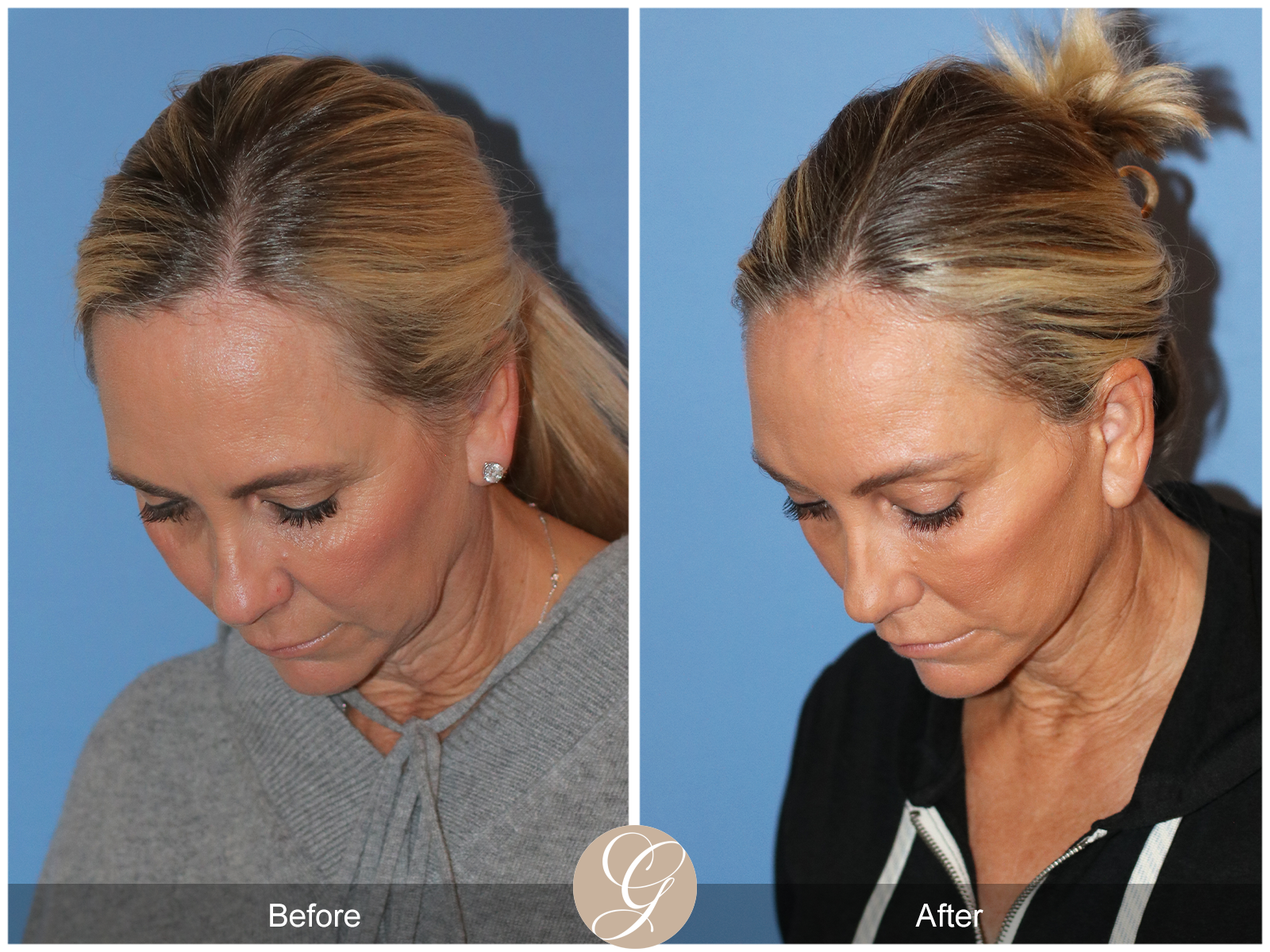 Deep Plane Facelift Case 41 Image