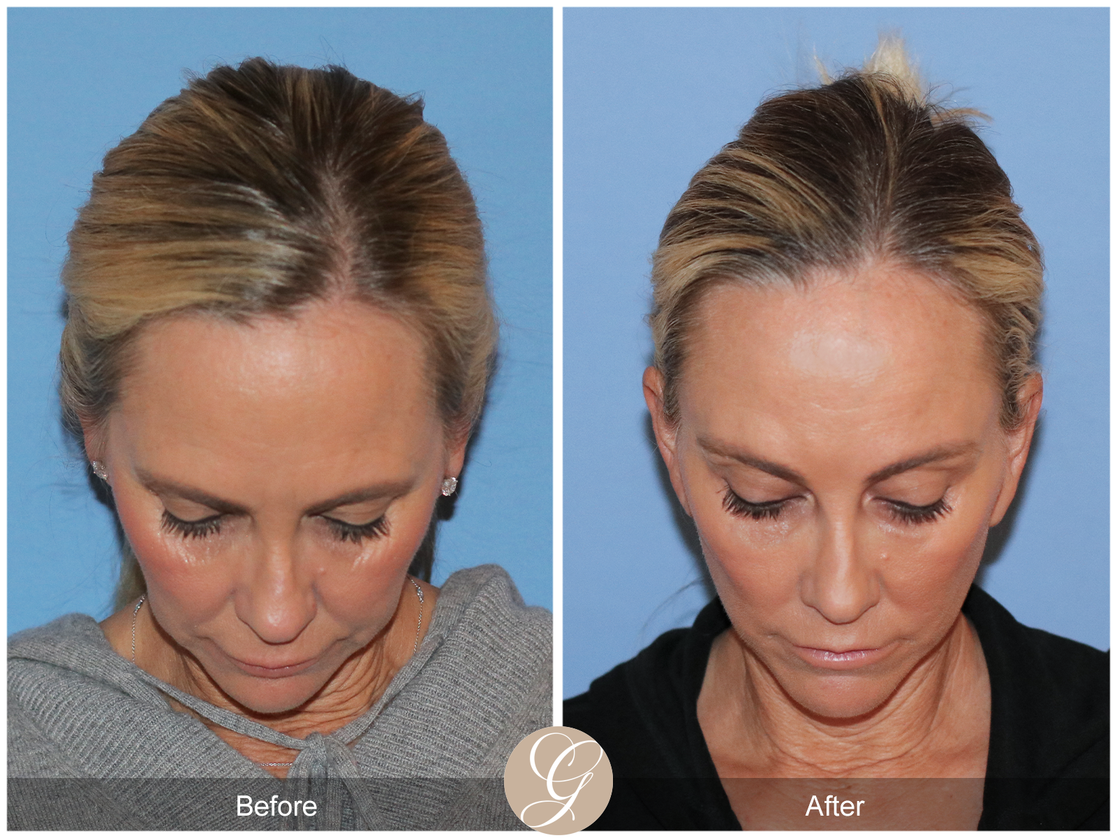 Deep Plane Facelift Case 41 Image