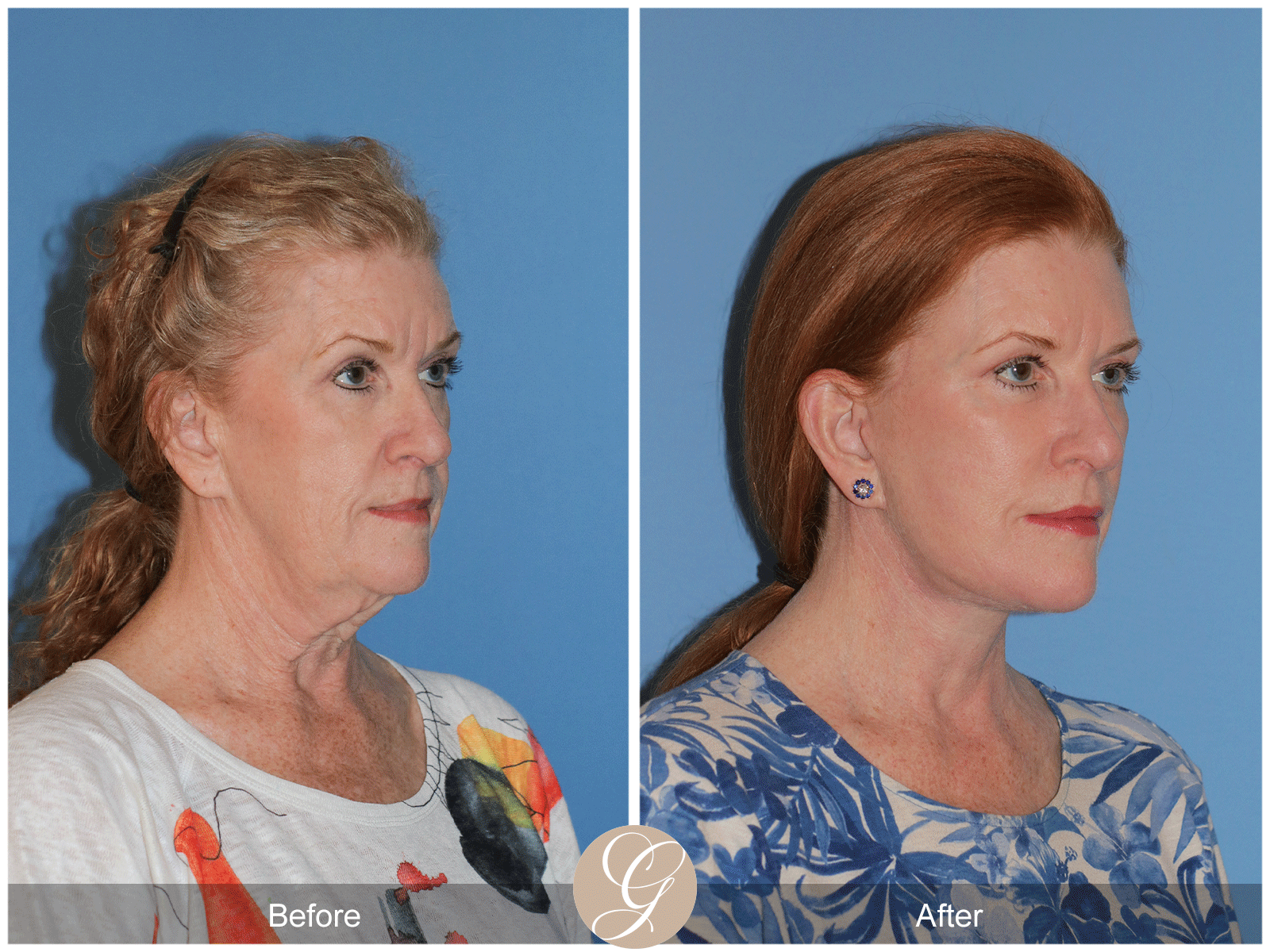 Deep Plane Facelift Case 30 Image