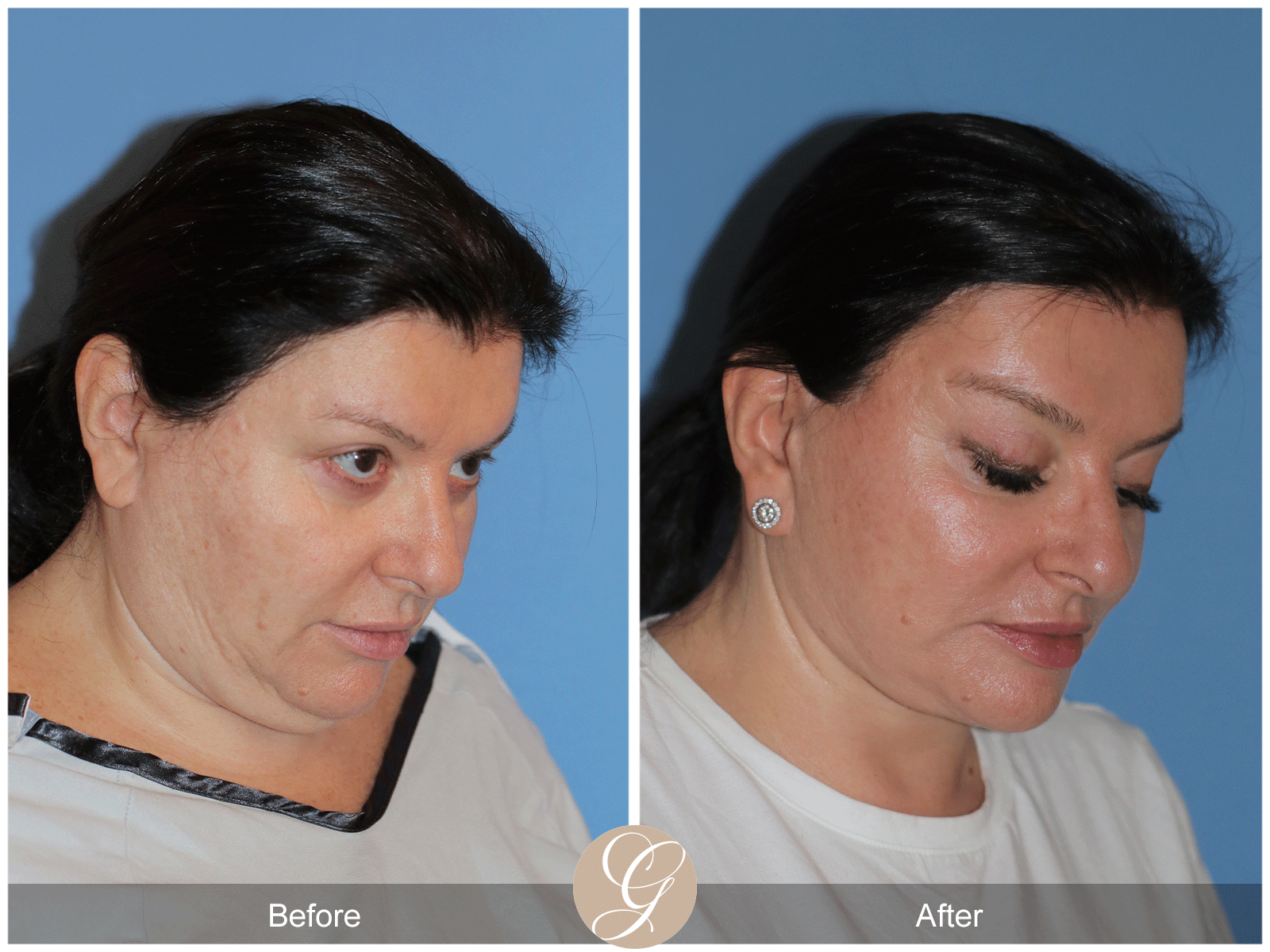 Preservation Deep Plane Facelift Case 40 Image