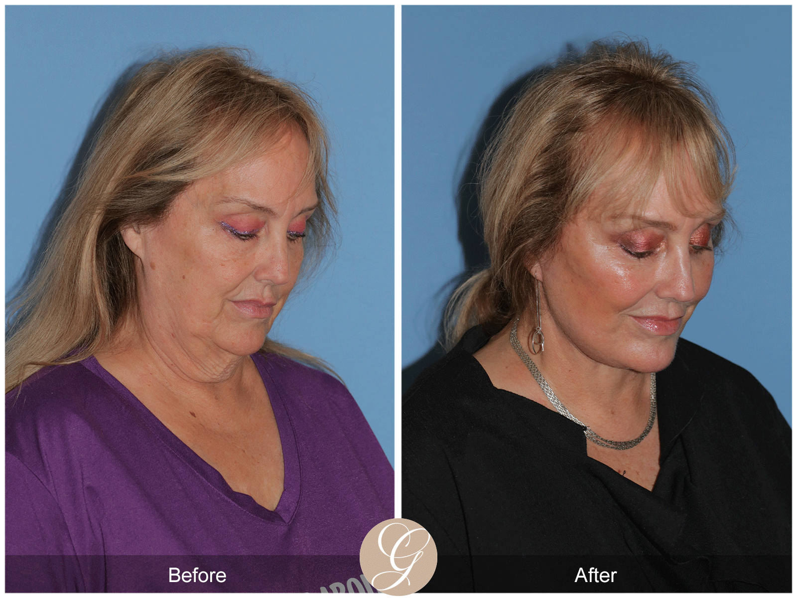Deep Plane Facelift Case 48 Image