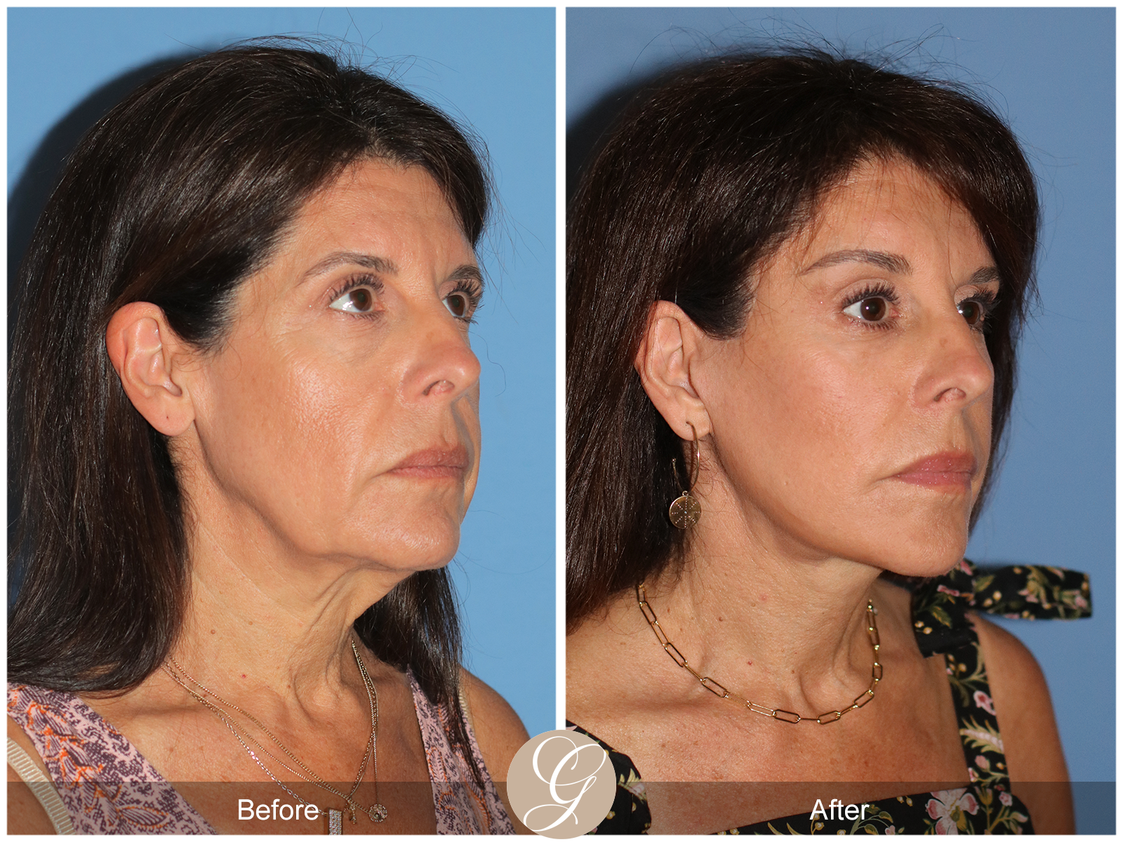 Deep Plane Facelift Case 32 Image