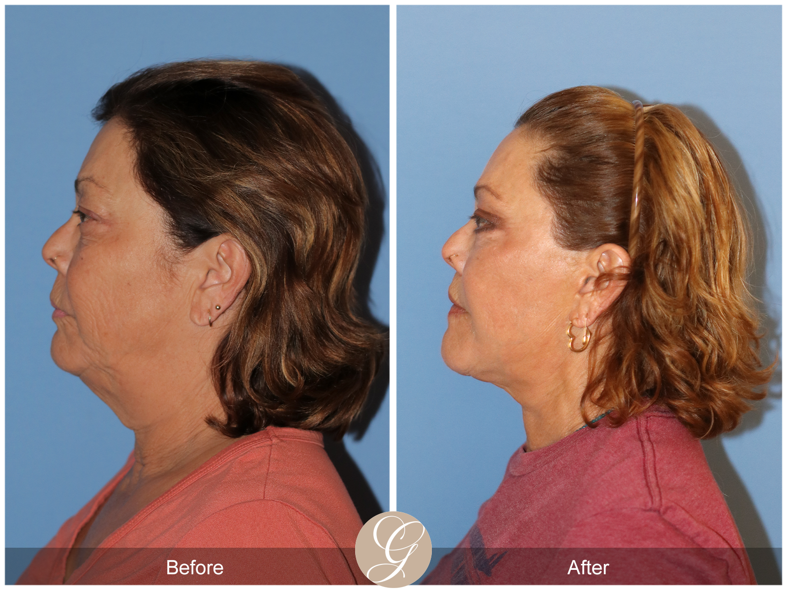 Deep Plane Facelift Case 37 Image