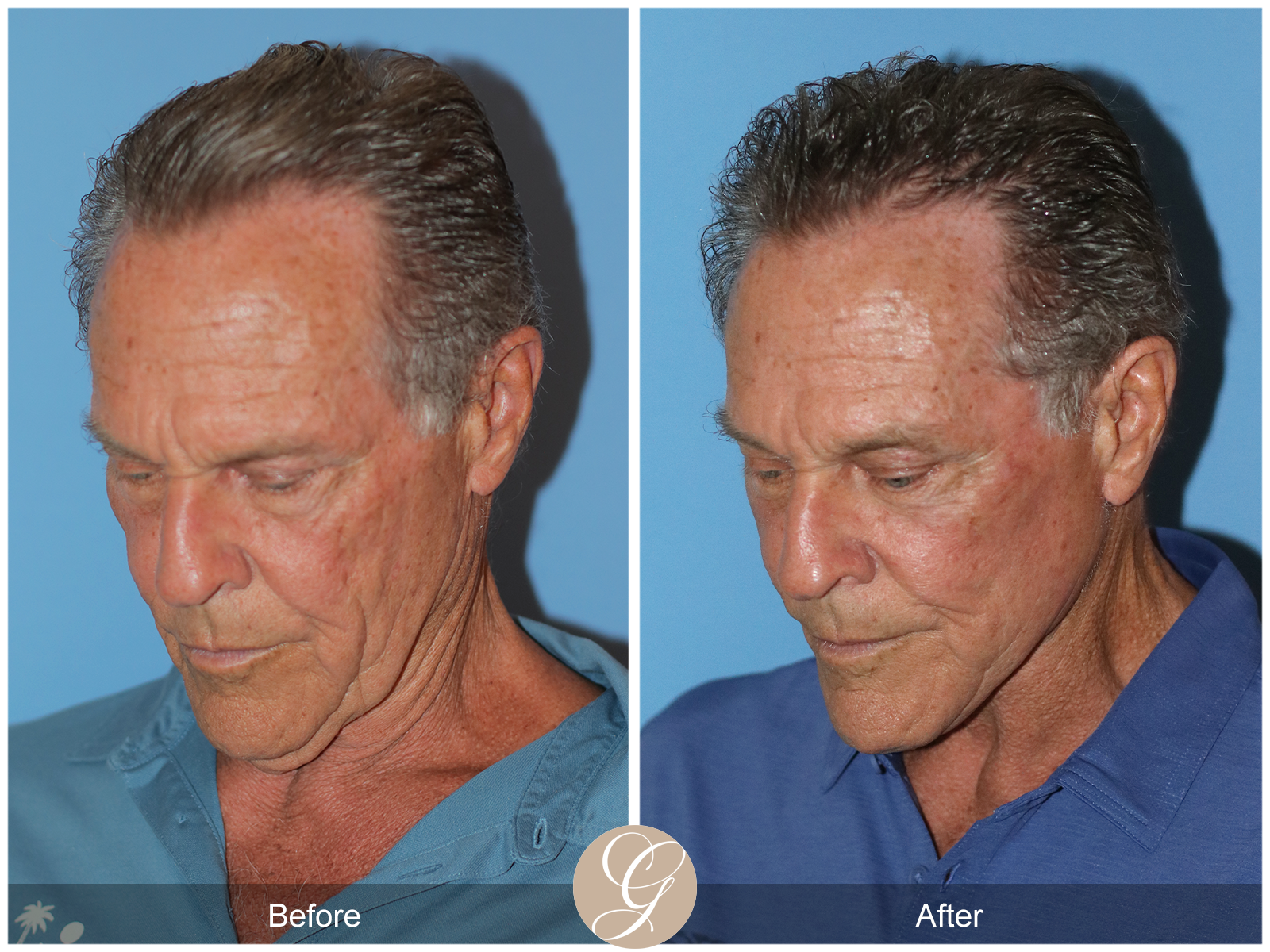 Preservation Deep Plane Facelift Case 36 Image