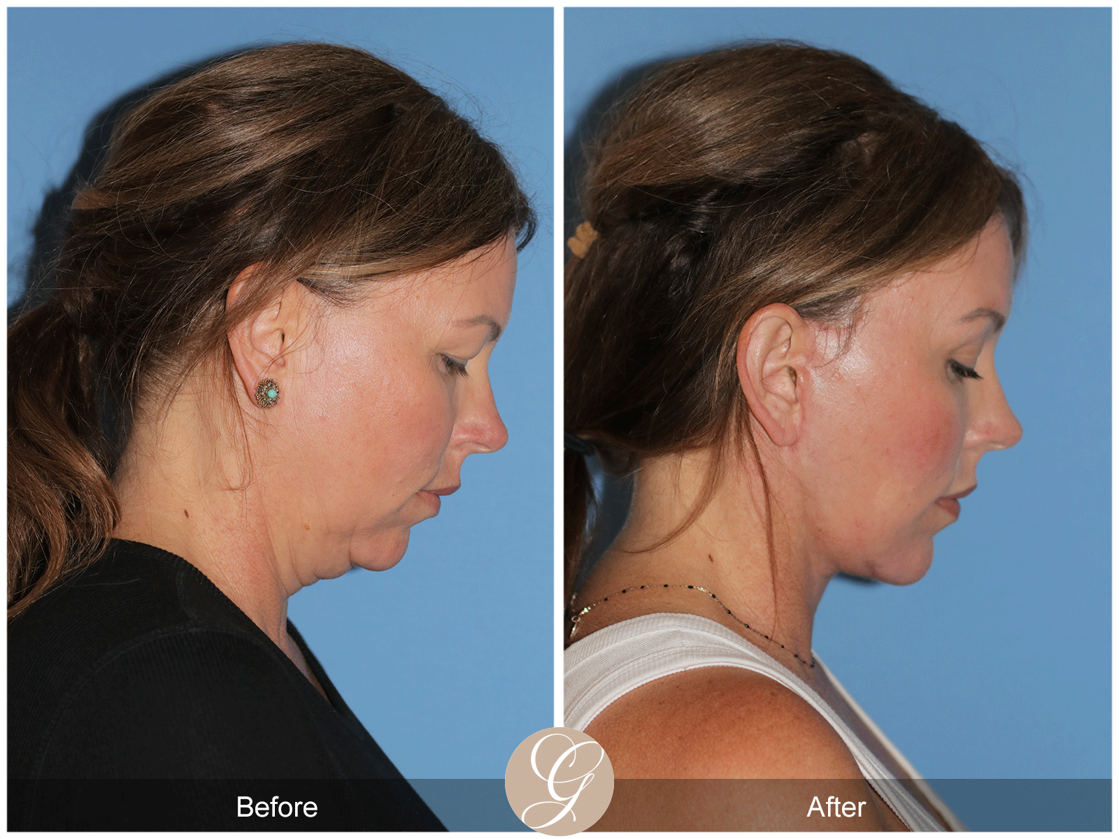 Deep Plane Facelift Case 33 Image