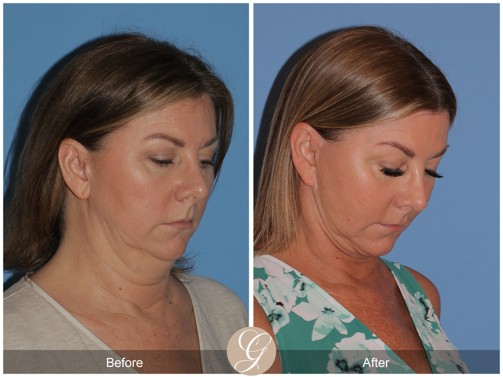 Preservation Deep Plane Facelift Case 37 Image