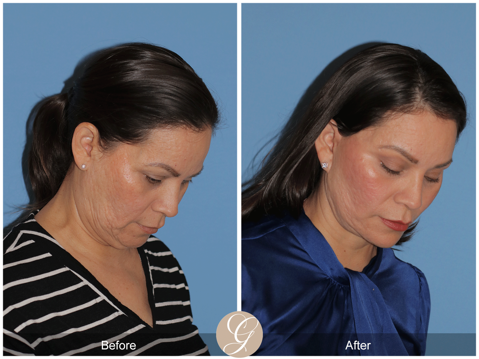 Deep Plane Facelift Case 27 Image