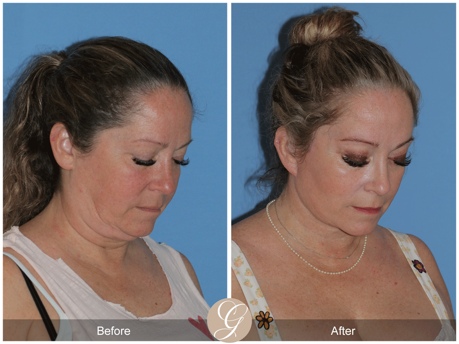 Deep Plane Facelift Case 28 Image