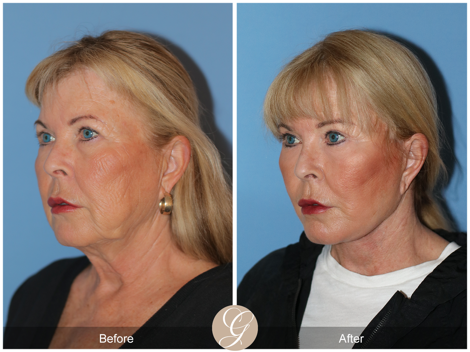 Preservation Deep Plane Facelift Case 35 Image