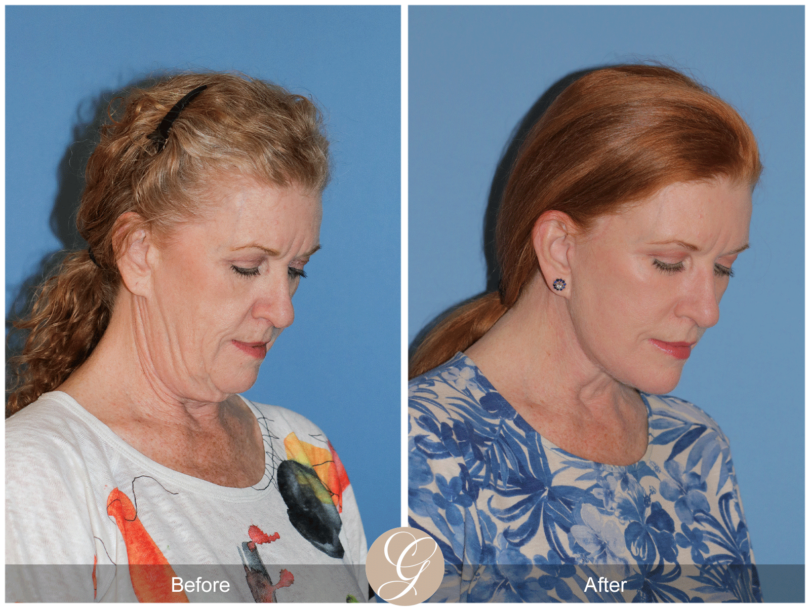 Deep Plane Facelift Case 30 Image