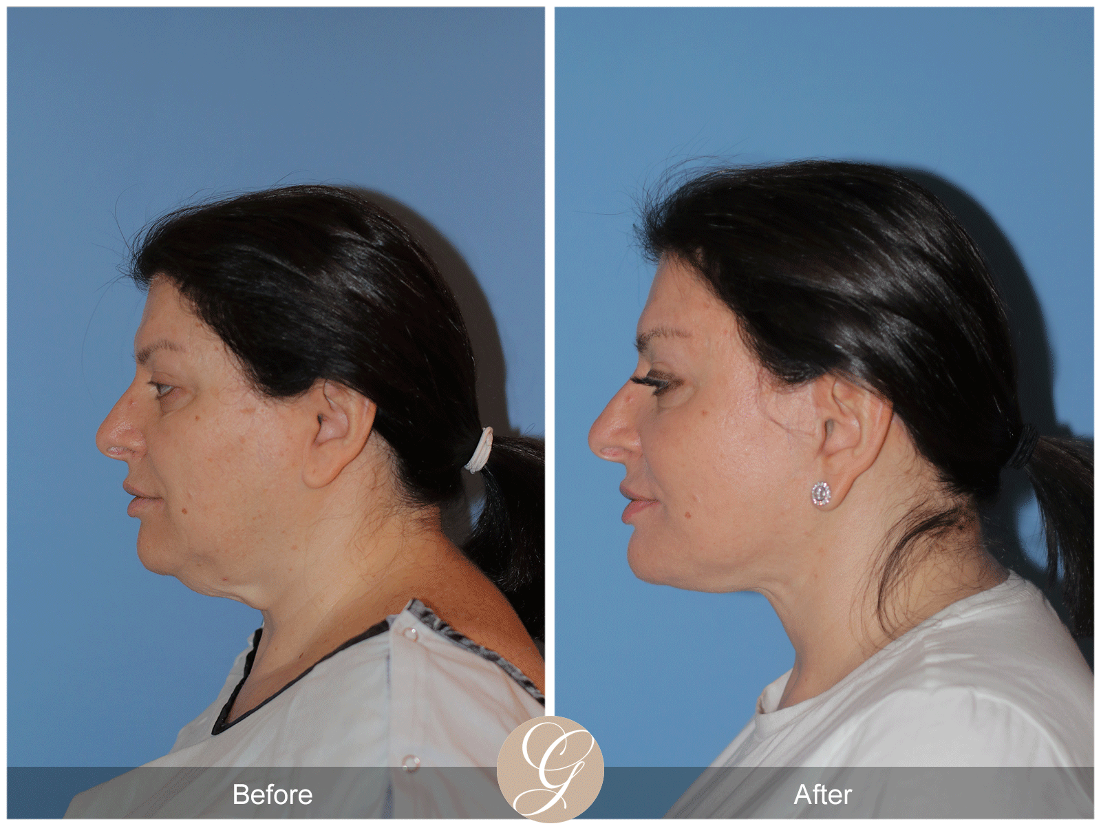 Preservation Deep Plane Facelift Case 40 Image