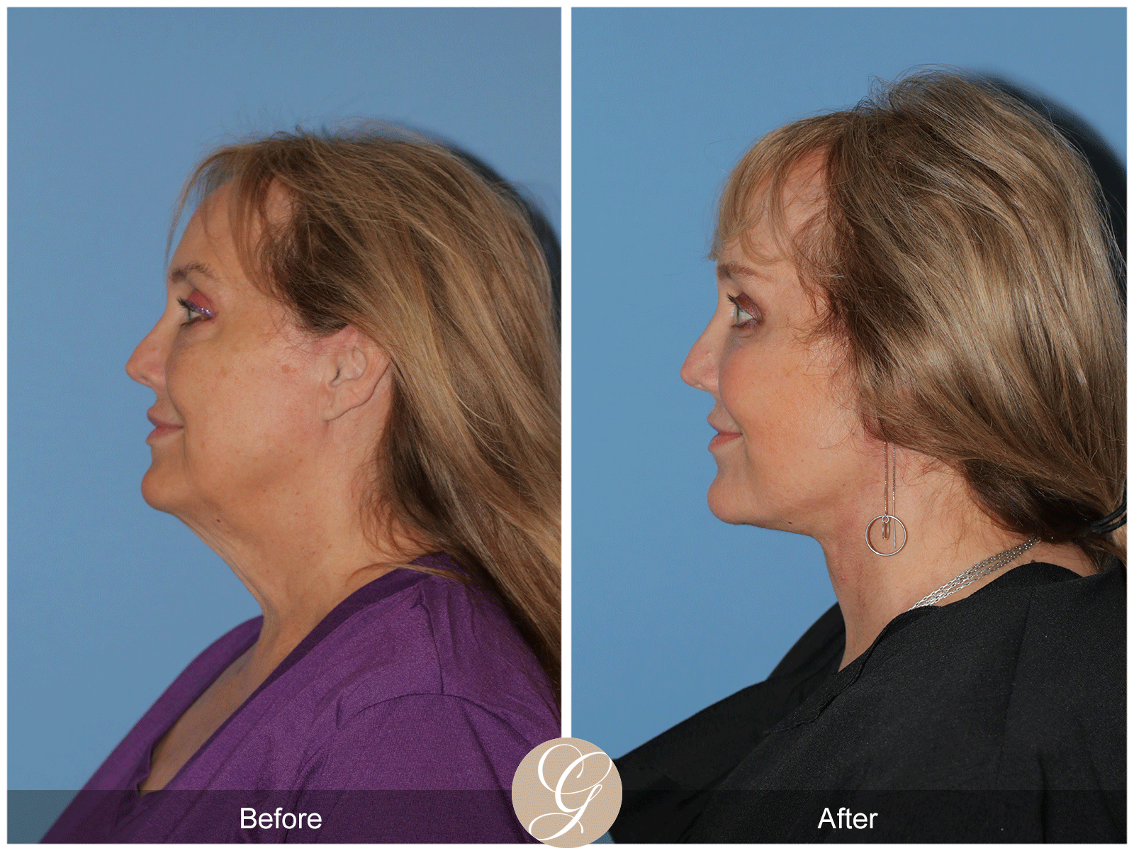 Deep Plane Facelift Case 48 Image
