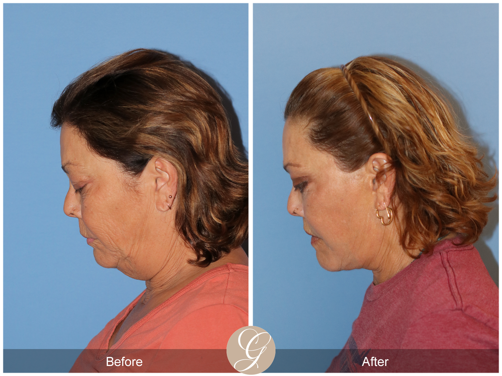 Deep Plane Facelift Case 37 Image