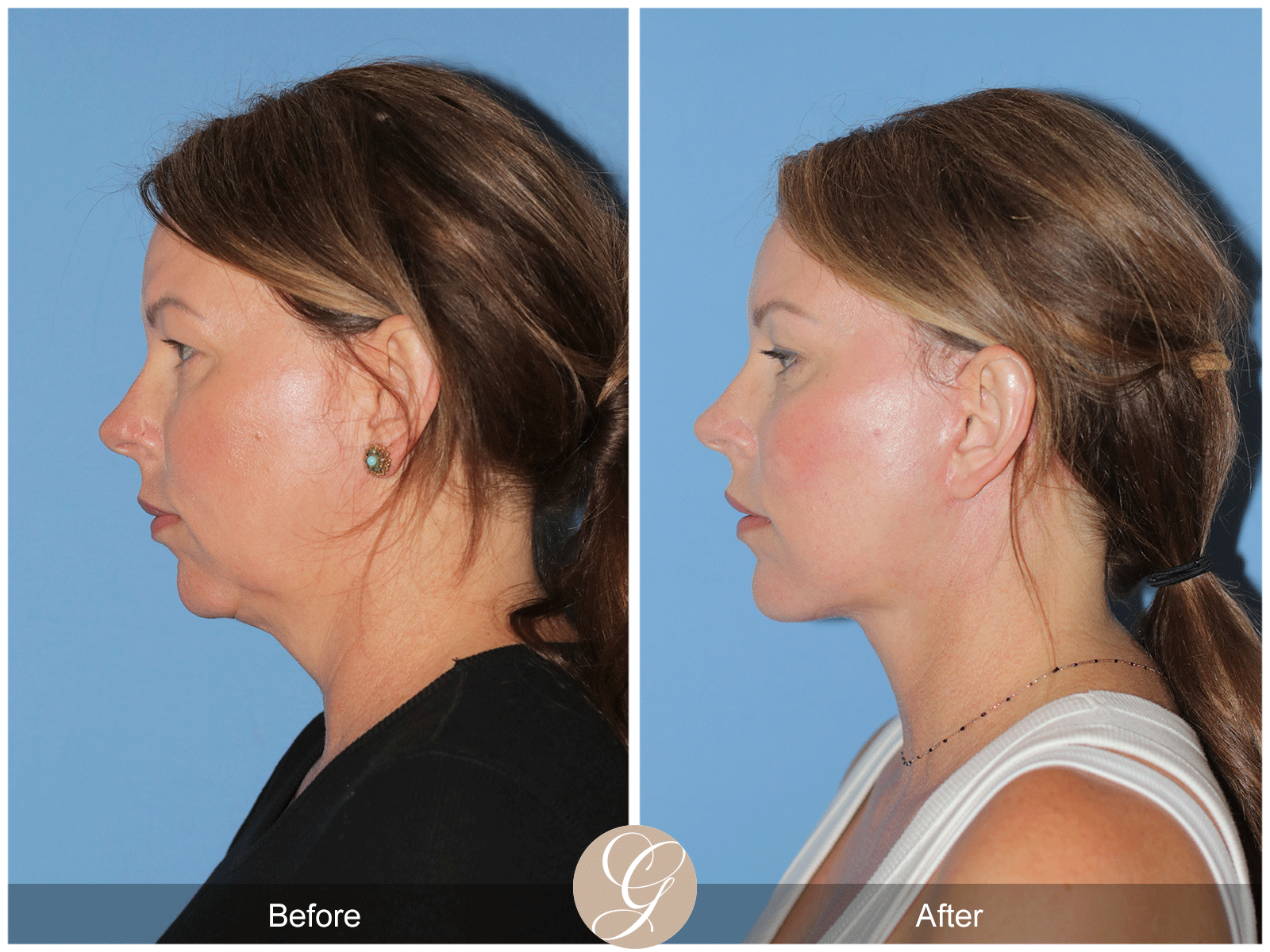 Deep Plane Facelift Case 33 Image