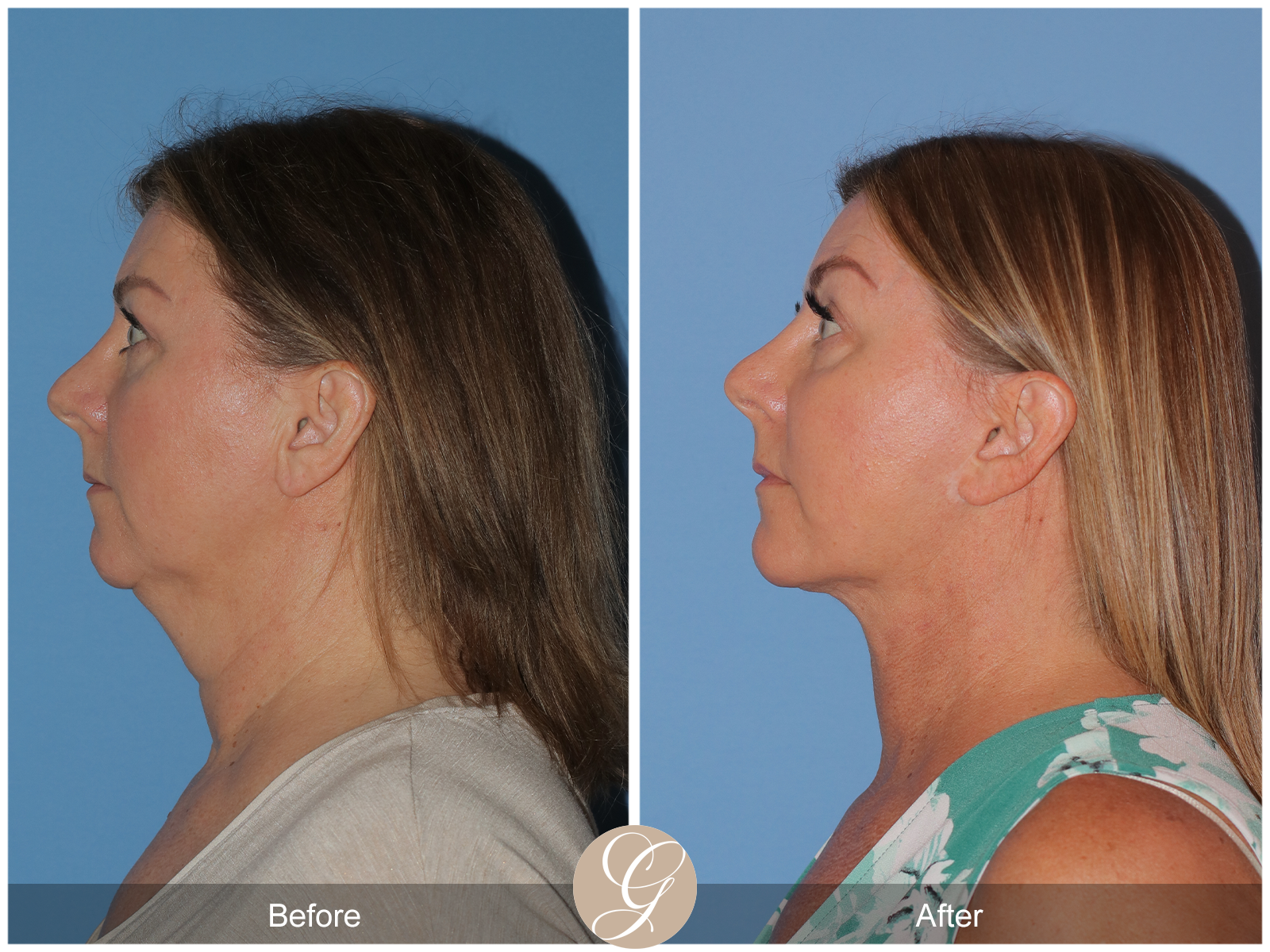 Preservation Deep Plane Facelift Case 37 Image