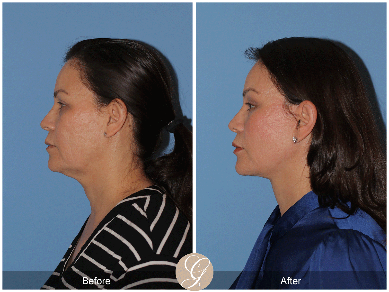 Deep Plane Facelift Case 27 Image