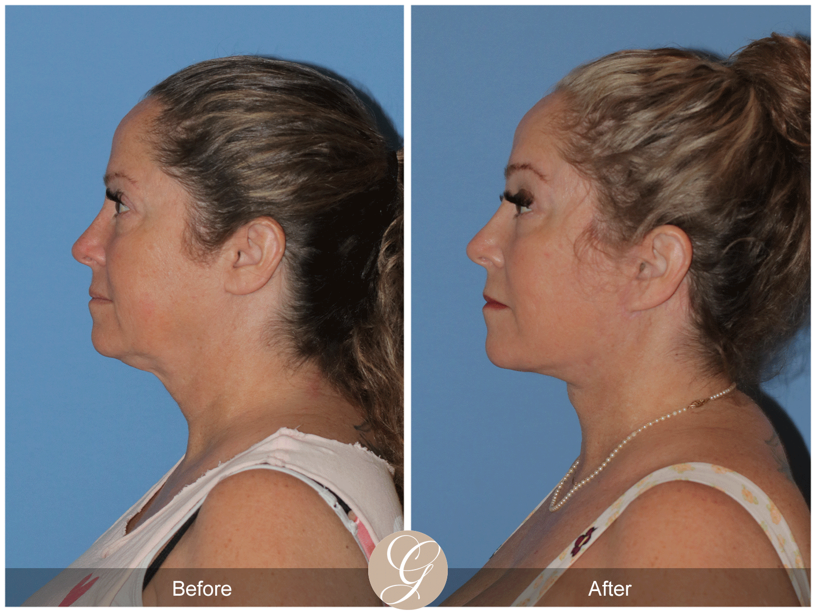 Deep Plane Facelift Case 28 Image