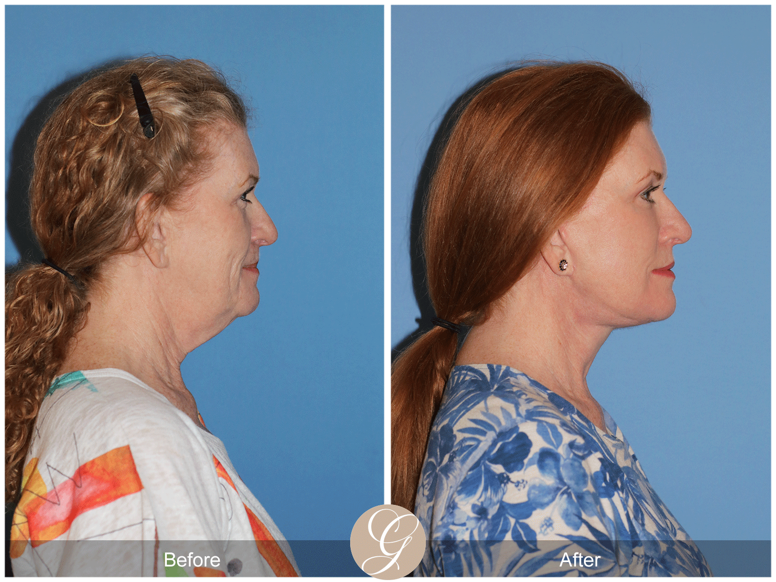 Deep Plane Facelift Case 30 Image
