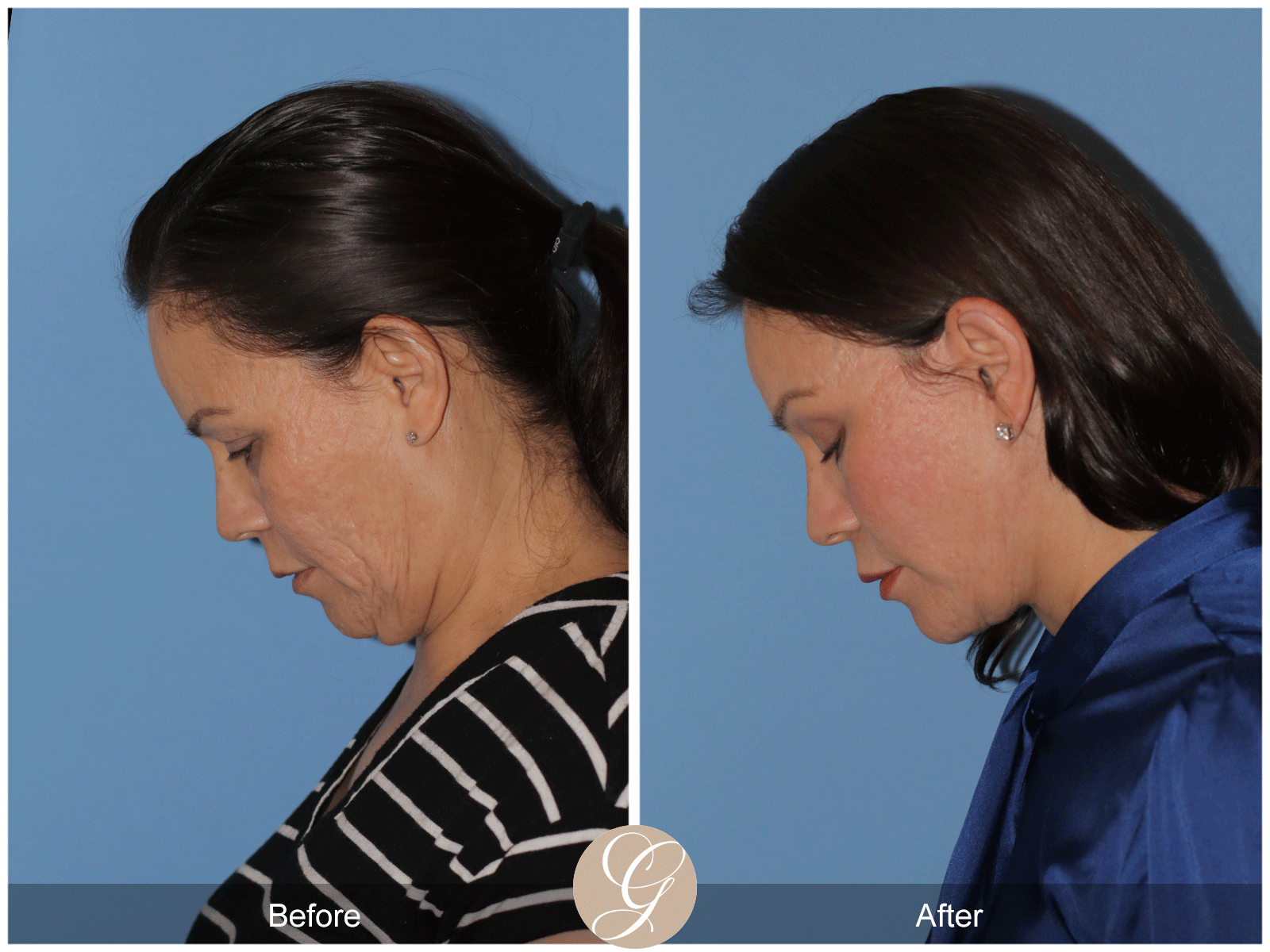 Deep Plane Facelift Case 27 Image