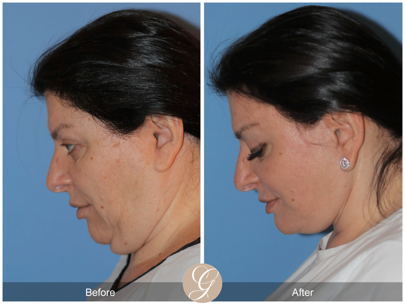 Preservation Deep Plane Facelift Case 40 Image